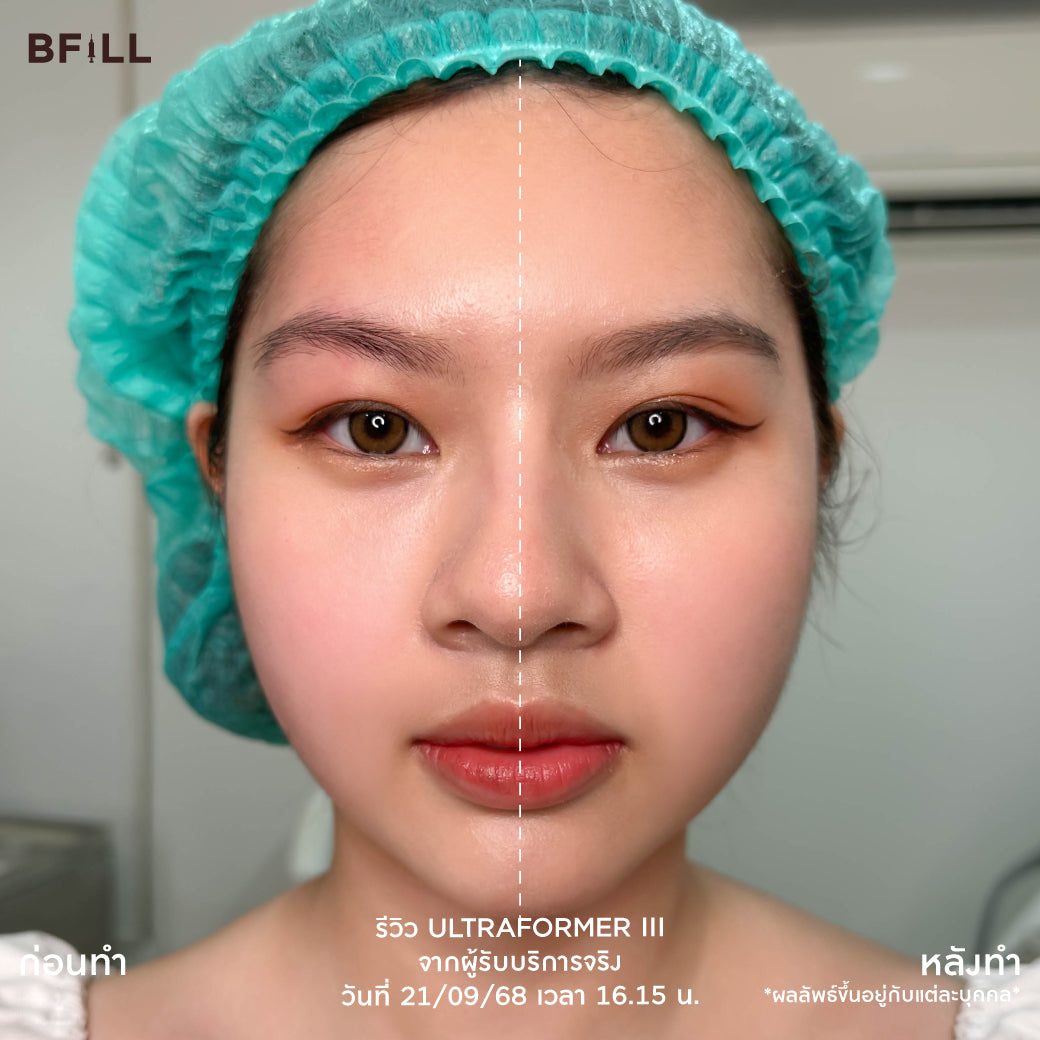 Ultra Former III 面部提升 by Doctor 不含麻醉（麻醉加200泰铢） 免费韩国热玛吉由专家提供