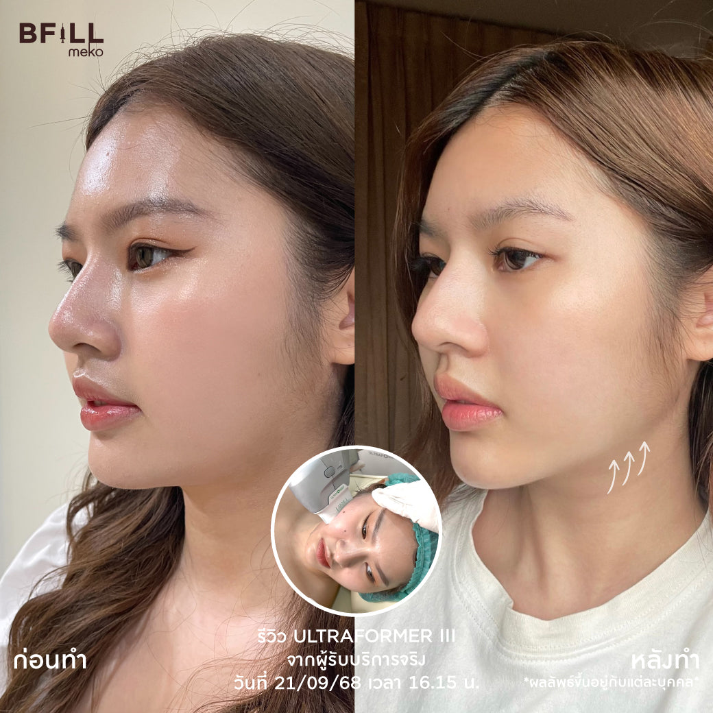 Program Ultraformer + Program Oligio by Doctor Only Asok ทำพร้อมกันในวันเดียว