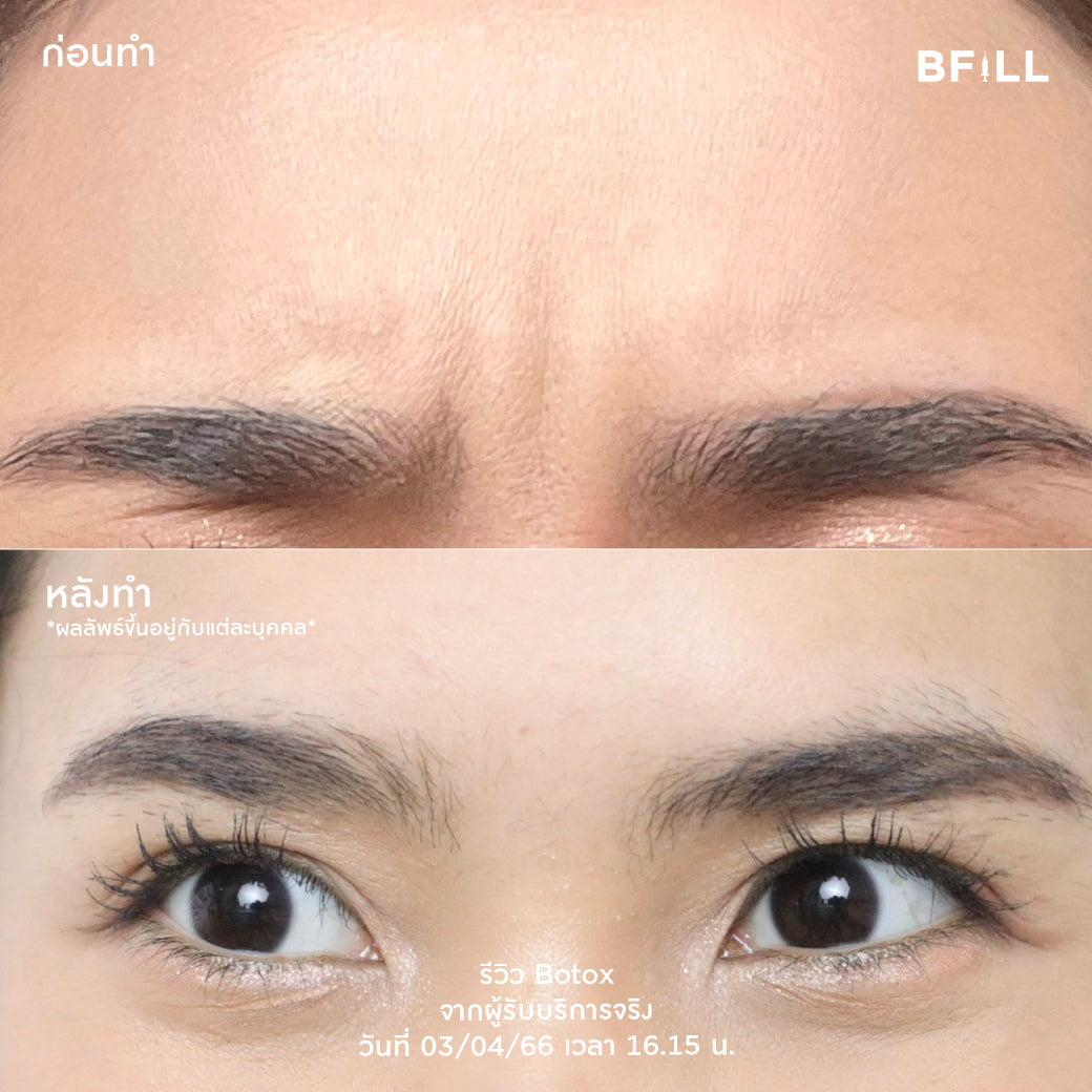 Program Botox Allergan 100u ผ่อน 12 เดือน 1599.-/เดือน  By Doctor