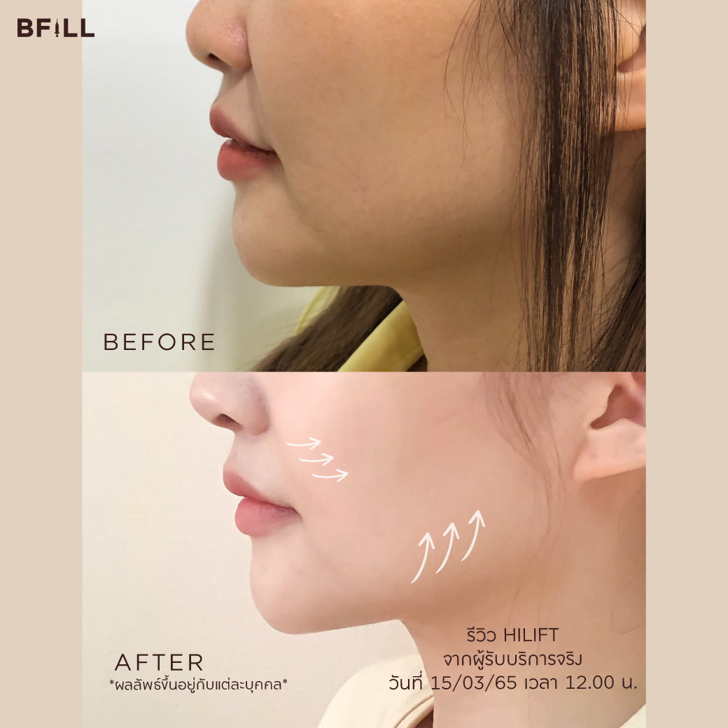 Hifu Hi Lift ไฮลิฟท์ by Specialist (由专家操作) "不包括额头 Excluding forehead" 可分期付款