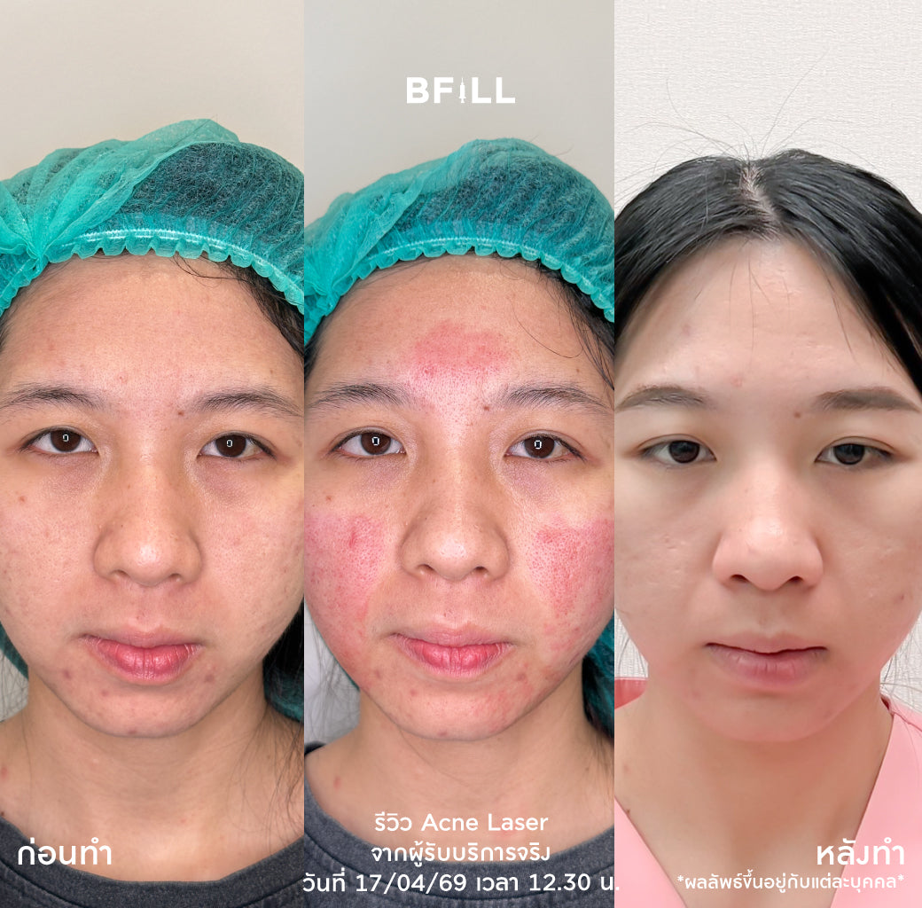 Program เลเซอร์กำจัดสิว Laser Only Asok