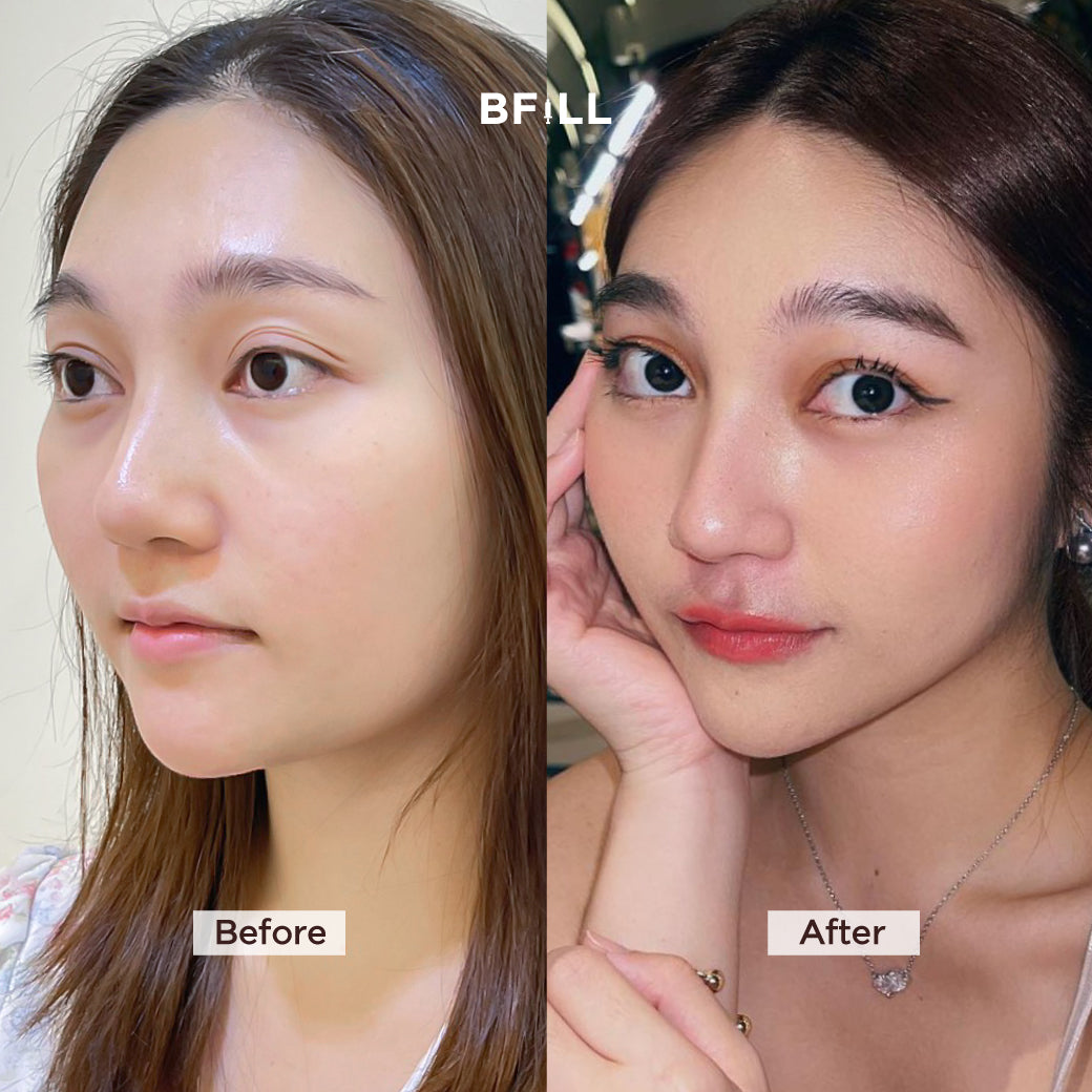 Botox Xeomin 100U โบท็อก เยอรมัน เลือกบริเวณฉีดได้ Only Asok