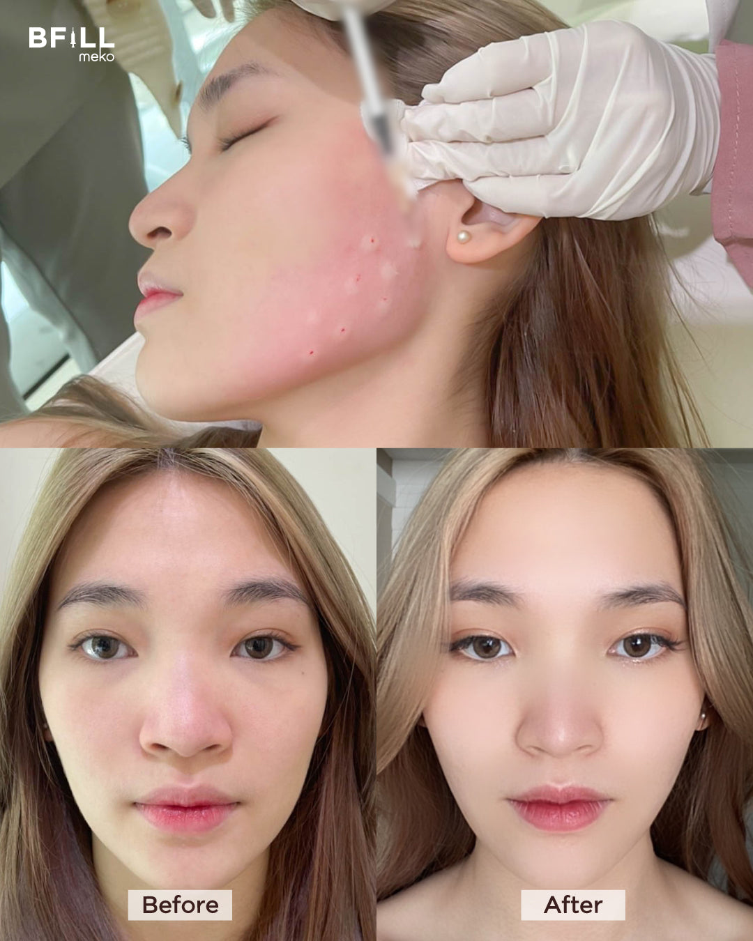 Botox Xeomin 100U โบท็อก เยอรมัน เลือกบริเวณฉีดได้ Only Asok