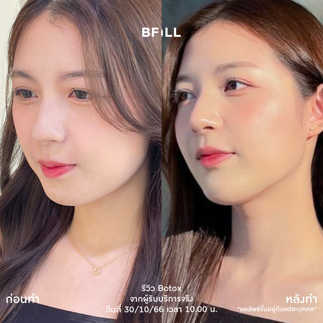 Program Botox Allergan 100u ผ่อน 12 เดือน 1599.-/เดือน  By Doctor