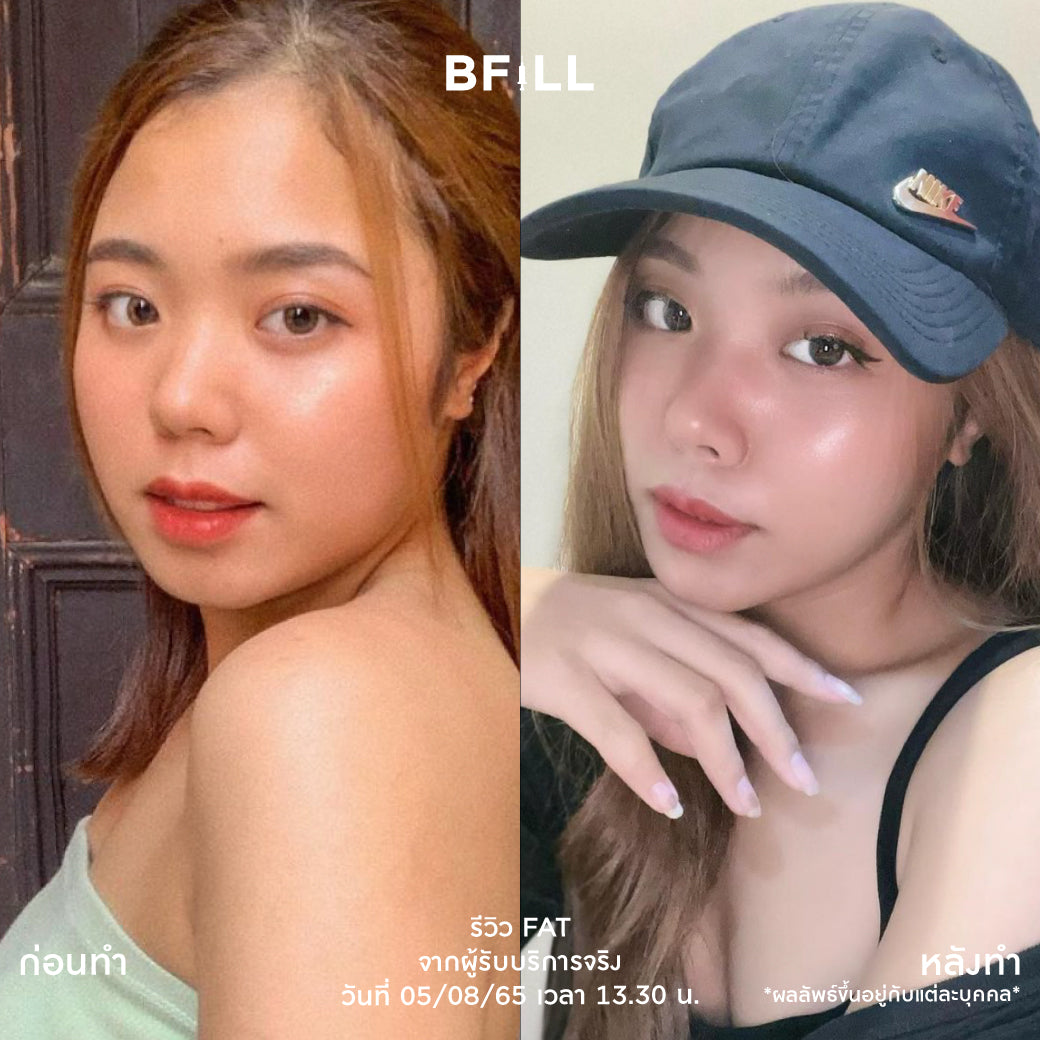 Fat Bomb 脂肪炸弹 脸颊 双下巴 脂肪分解