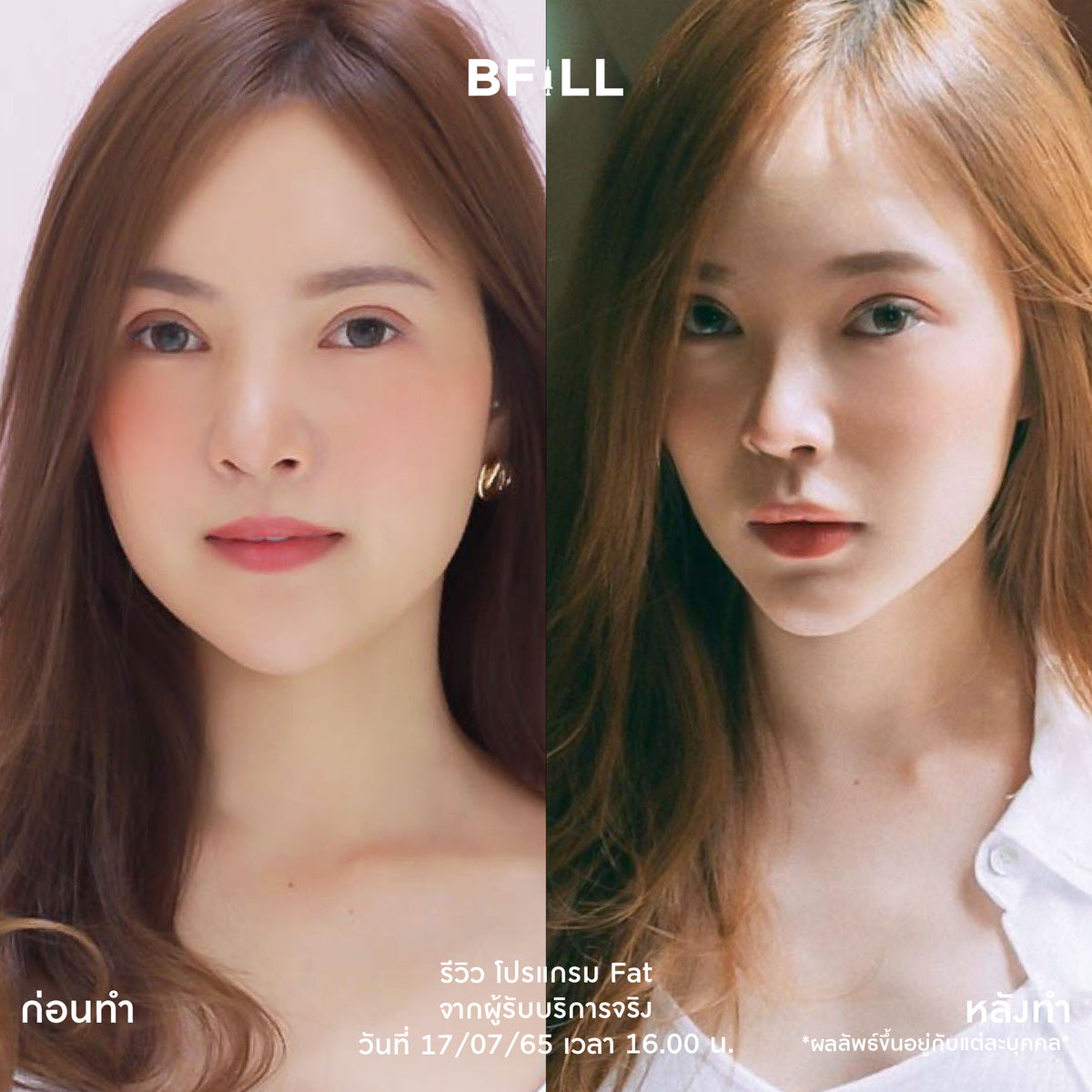 Program Fat Face Treatment: Cheeks and Double Chin Fat Reduction