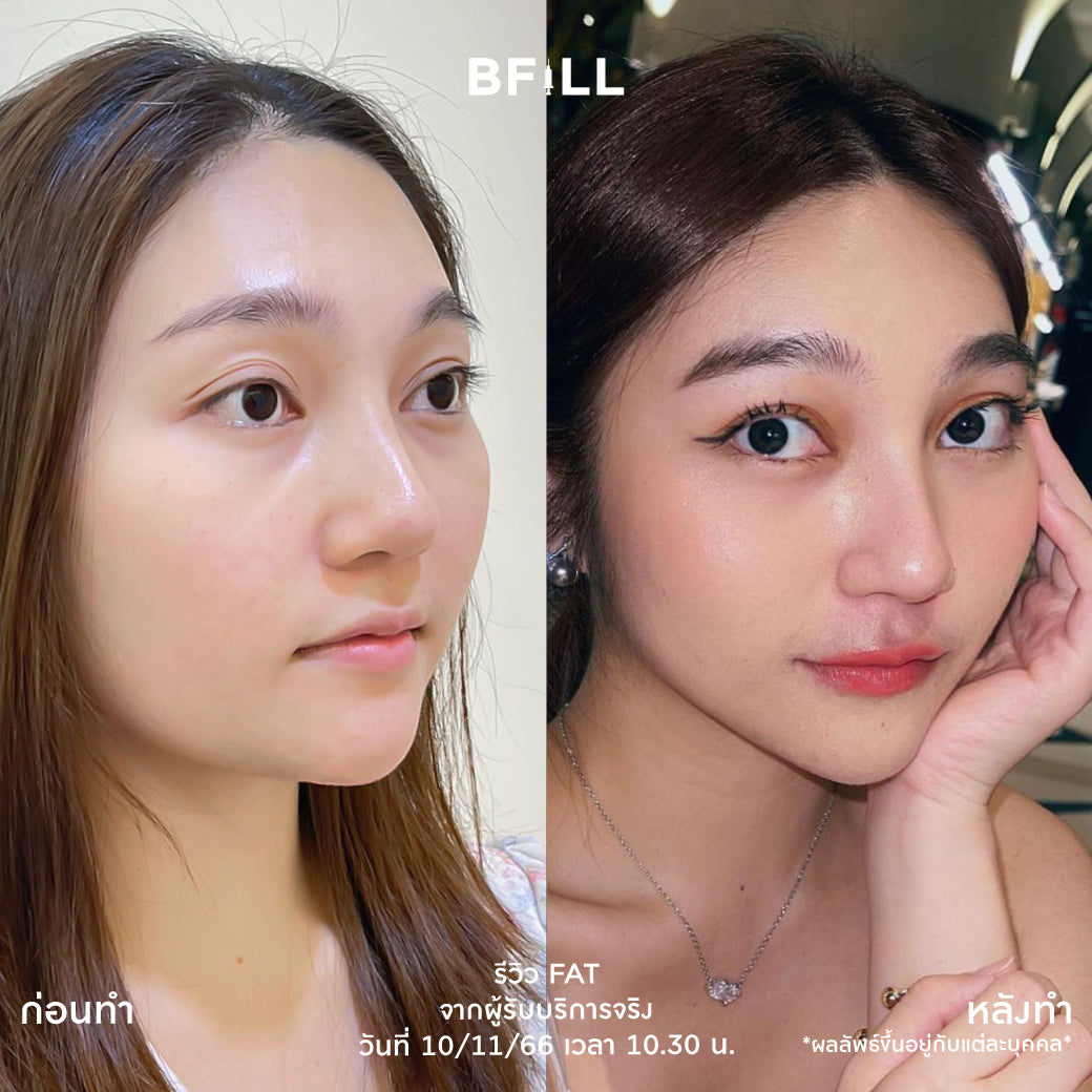 Fat Bomb 脂肪炸弹 脸颊 双下巴 脂肪分解