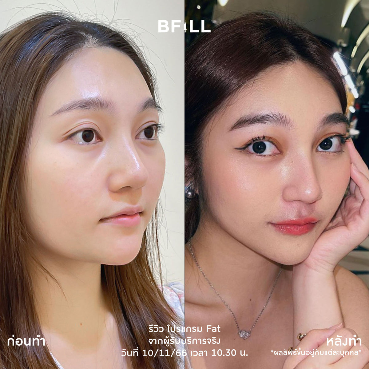Program Fat Face Treatment: Cheeks and Double Chin Fat Reduction