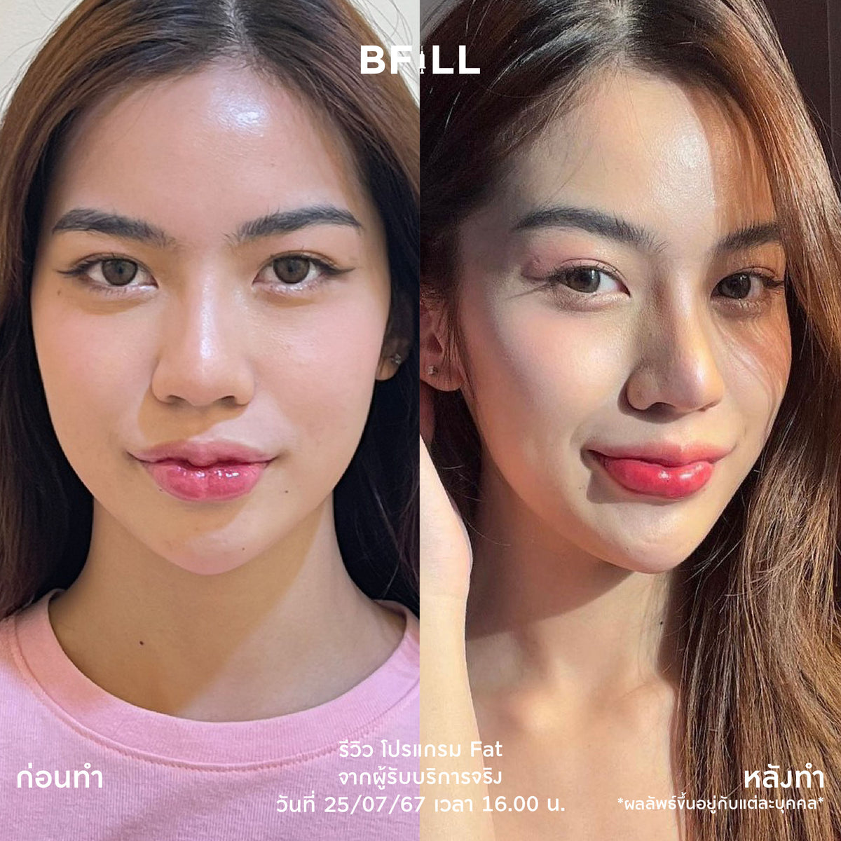 Program Fat Face Treatment: Cheeks and Double Chin Fat Reduction