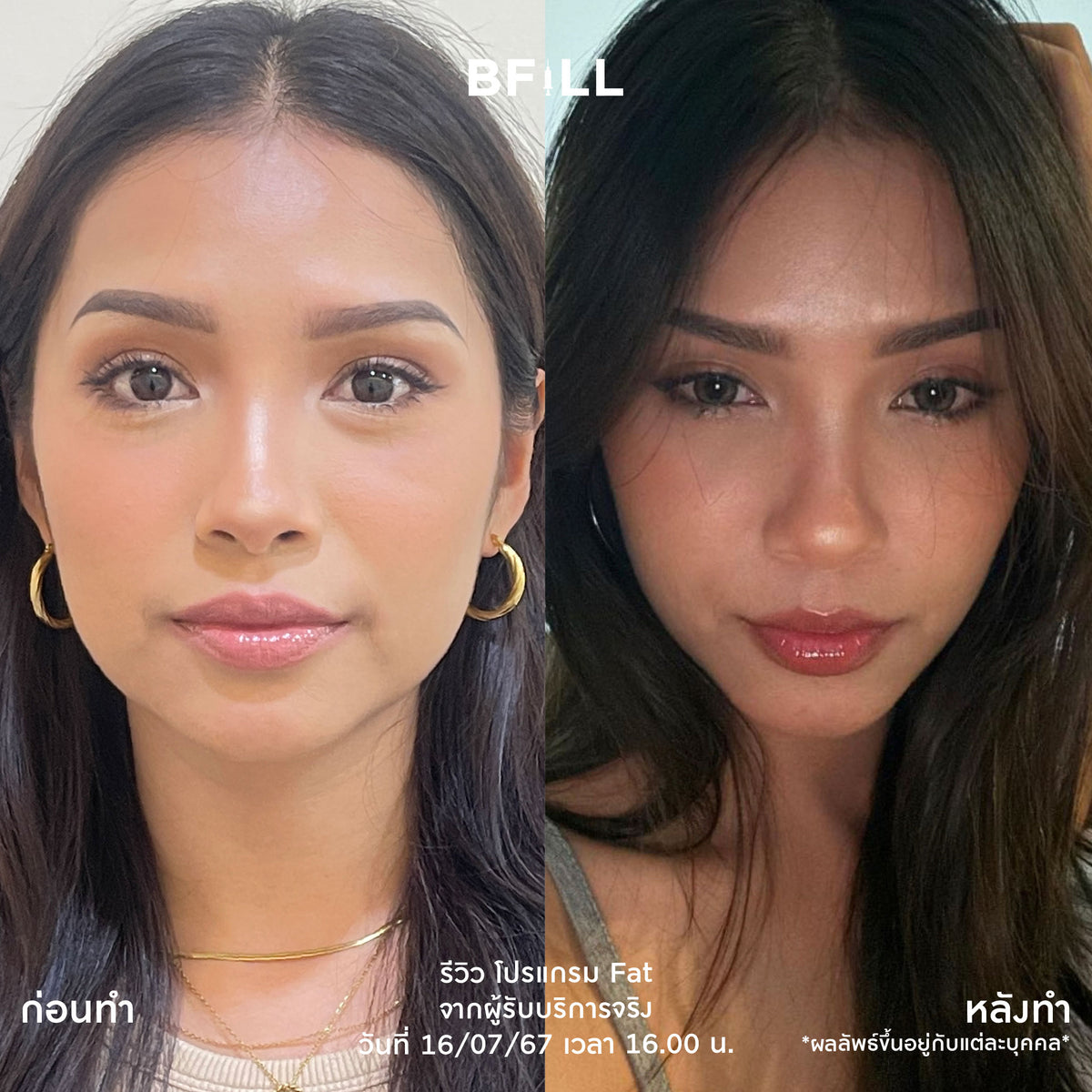 Program Fat Face Treatment: Cheeks and Double Chin Fat Reduction