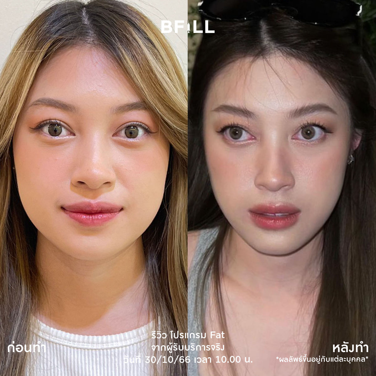 Program Fat Face Treatment: Cheeks and Double Chin Fat Reduction