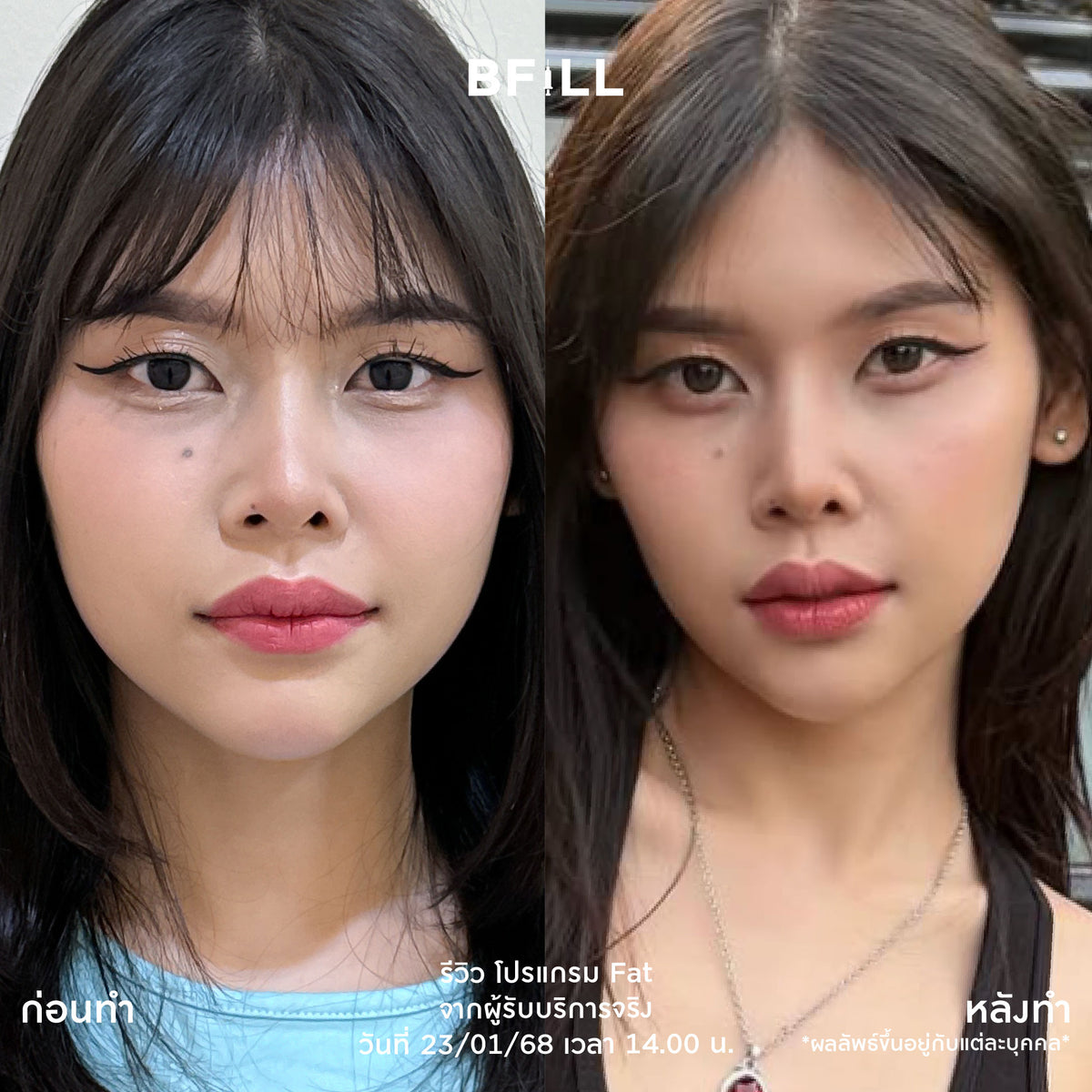Program Fat Face Treatment: Cheeks and Double Chin Fat Reduction