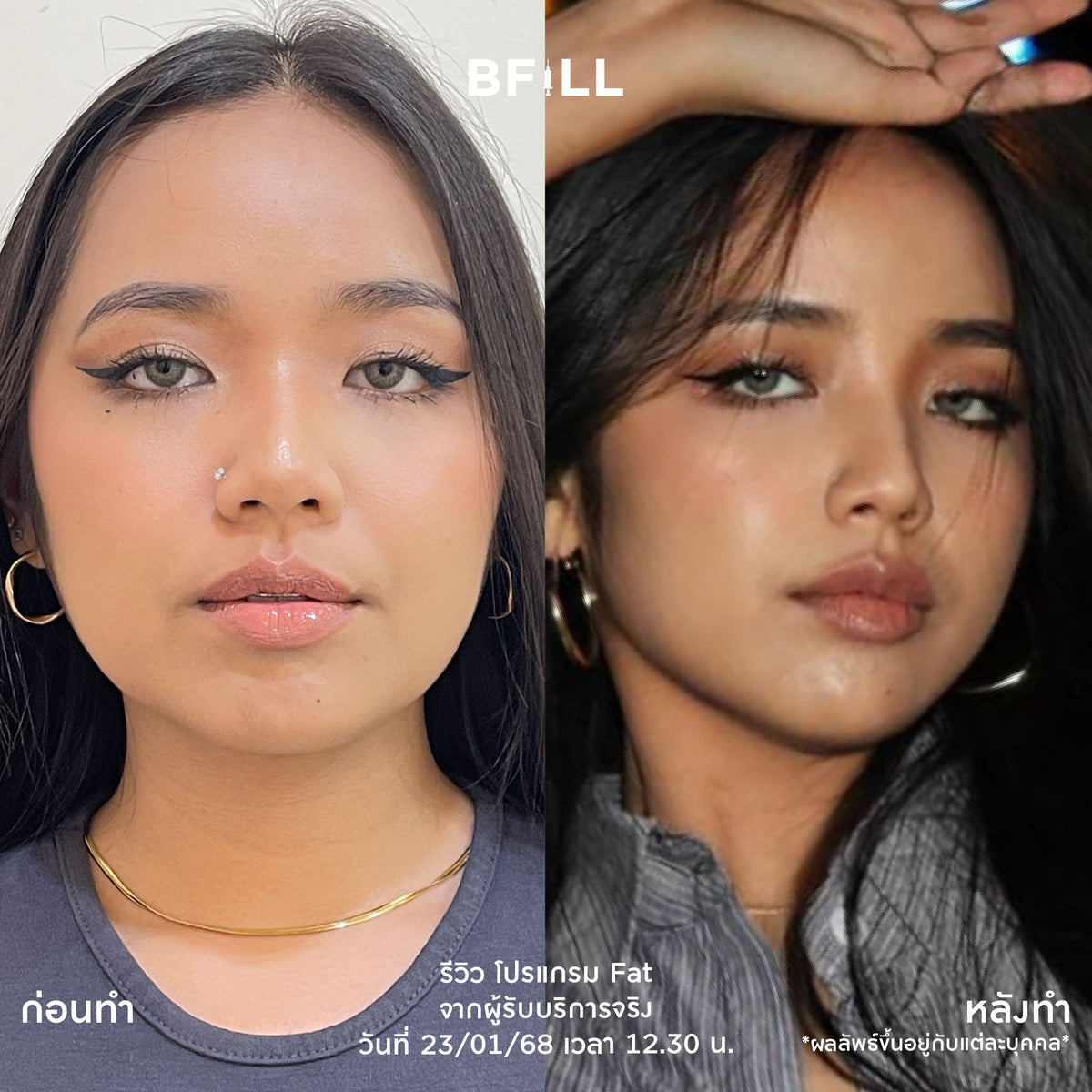 Program Fat Face Treatment: Cheeks and Double Chin Fat Reduction