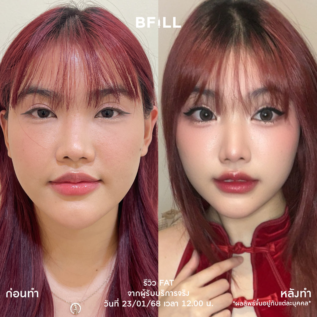 Fat Bomb 脂肪炸弹 脸颊 双下巴 脂肪分解