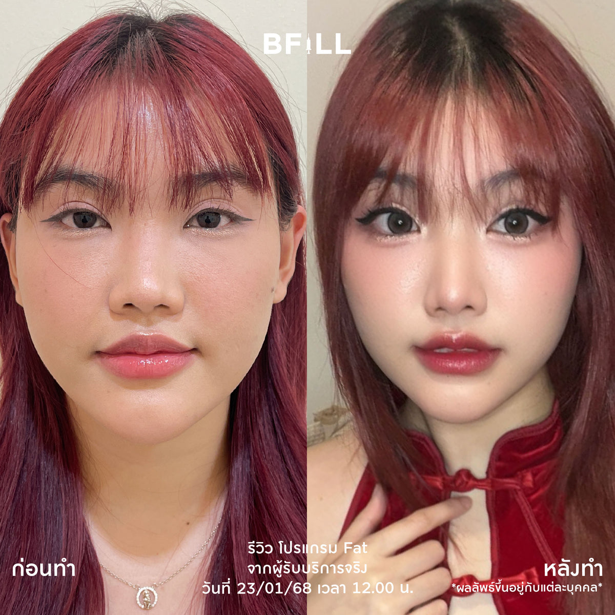 Program Fat Face Treatment: Cheeks and Double Chin Fat Reduction