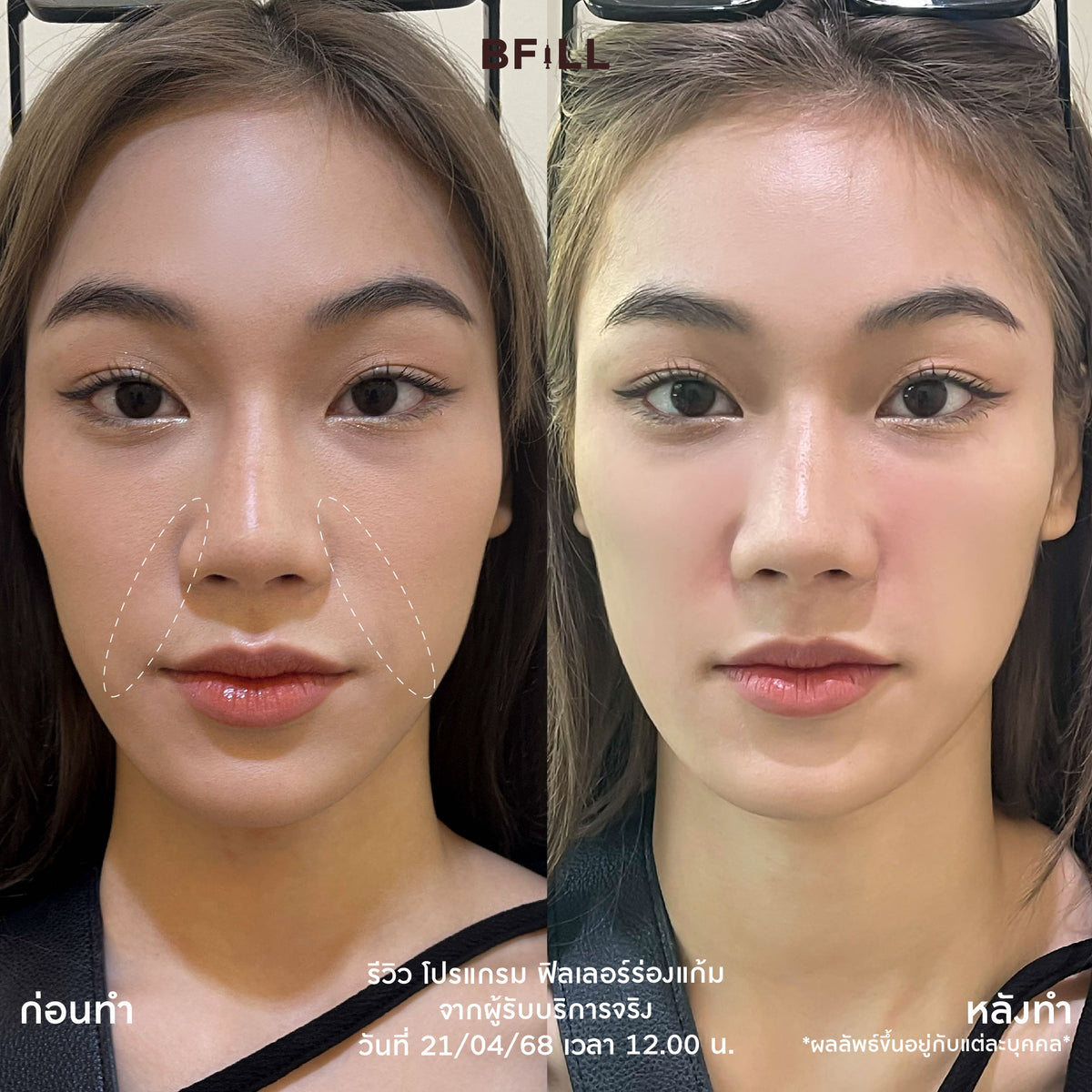 Program FILLER Neuramis or E.P.T.Q. or Volifil or Lorient or Restylane or Juvederm