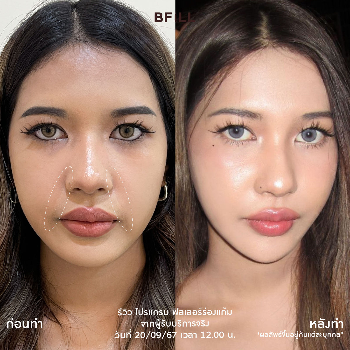 Program FILLER Neuramis or E.P.T.Q. or Volifil or Lorient or Restylane or Juvederm