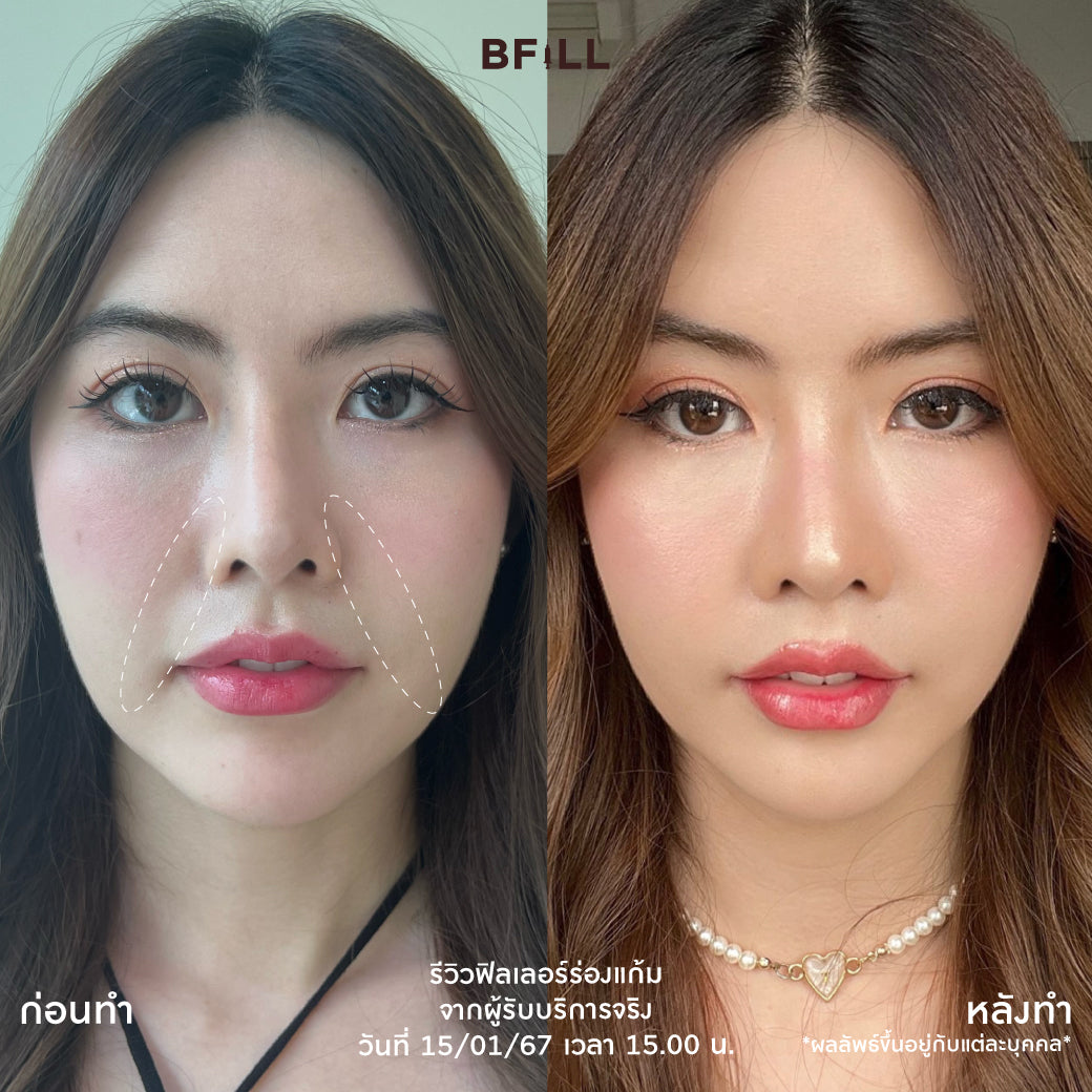 Program FILLER Neuramis or E.P.T.Q. or Volifil or Restylane or Juvederm