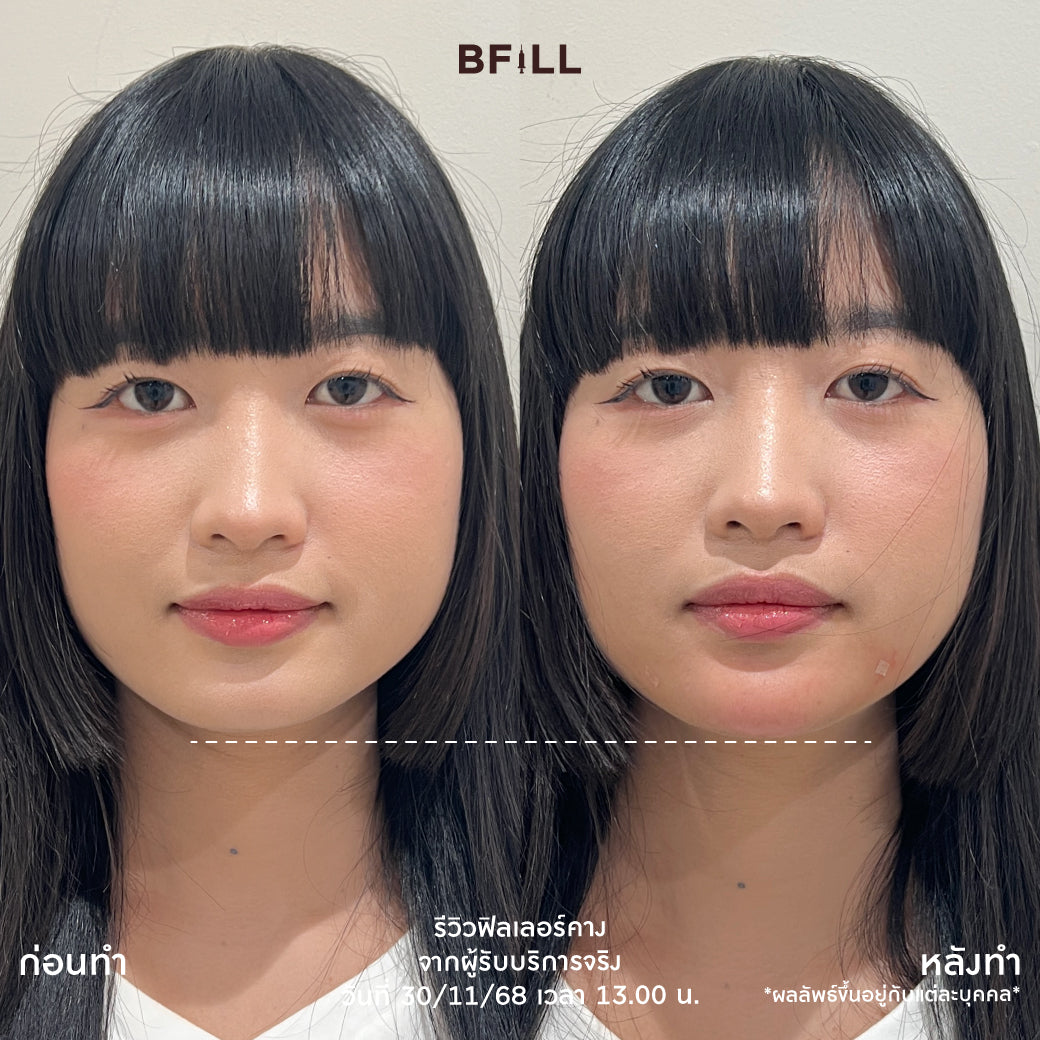 Program FILLER Neuramis or E.P.T.Q. or Volifil or Restylane or Juvederm