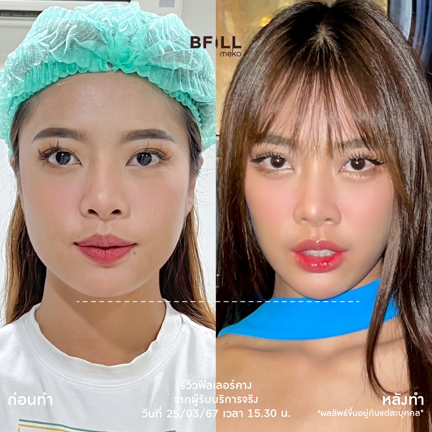 FILLER 韩国或瑞蓝或乔雅登