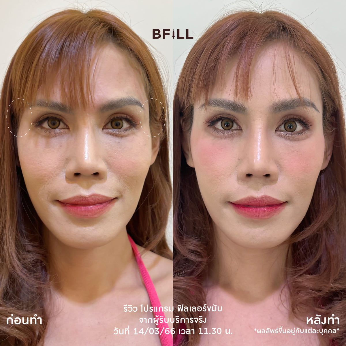 Program FILLER Neuramis or E.P.T.Q. or Volifil or Lorient or Restylane or Juvederm