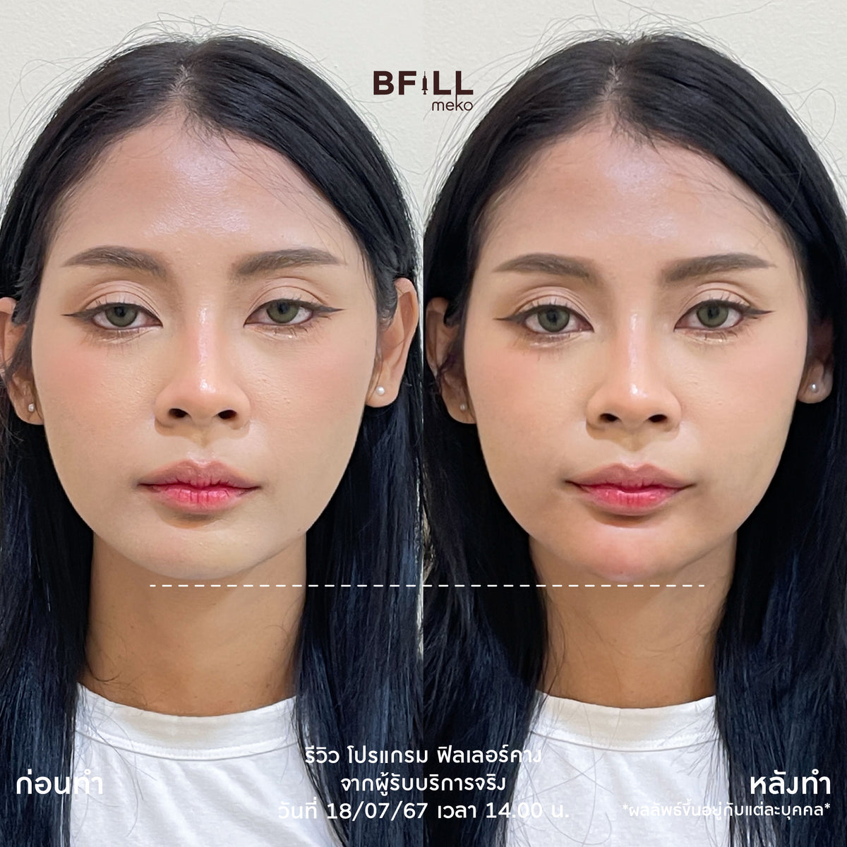 Program FILLER Neuramis or E.P.T.Q. or Volifil or Lorient or Restylane or Juvederm