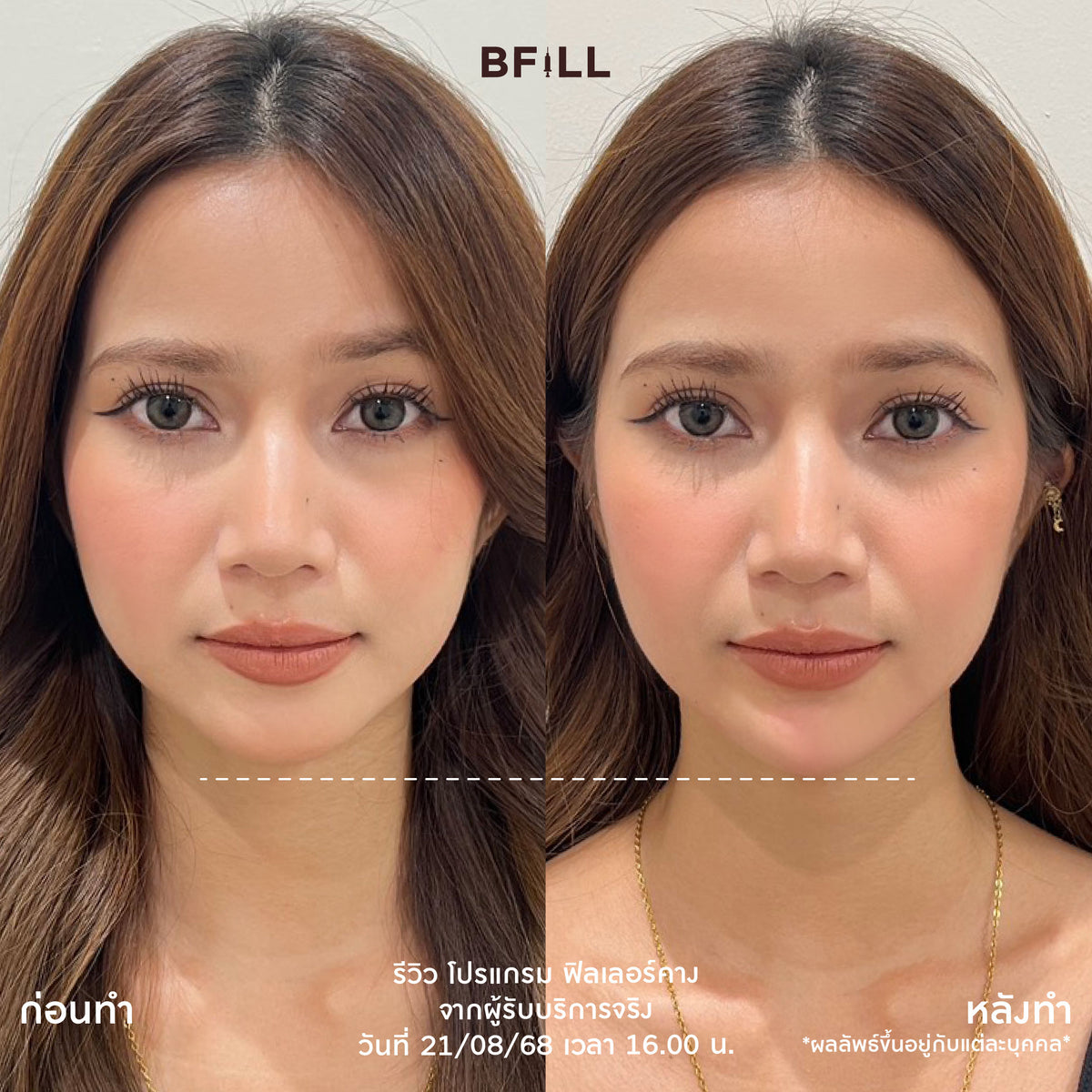 Program FILLER Neuramis or E.P.T.Q. or Volifil or Lorient or Restylane or Juvederm