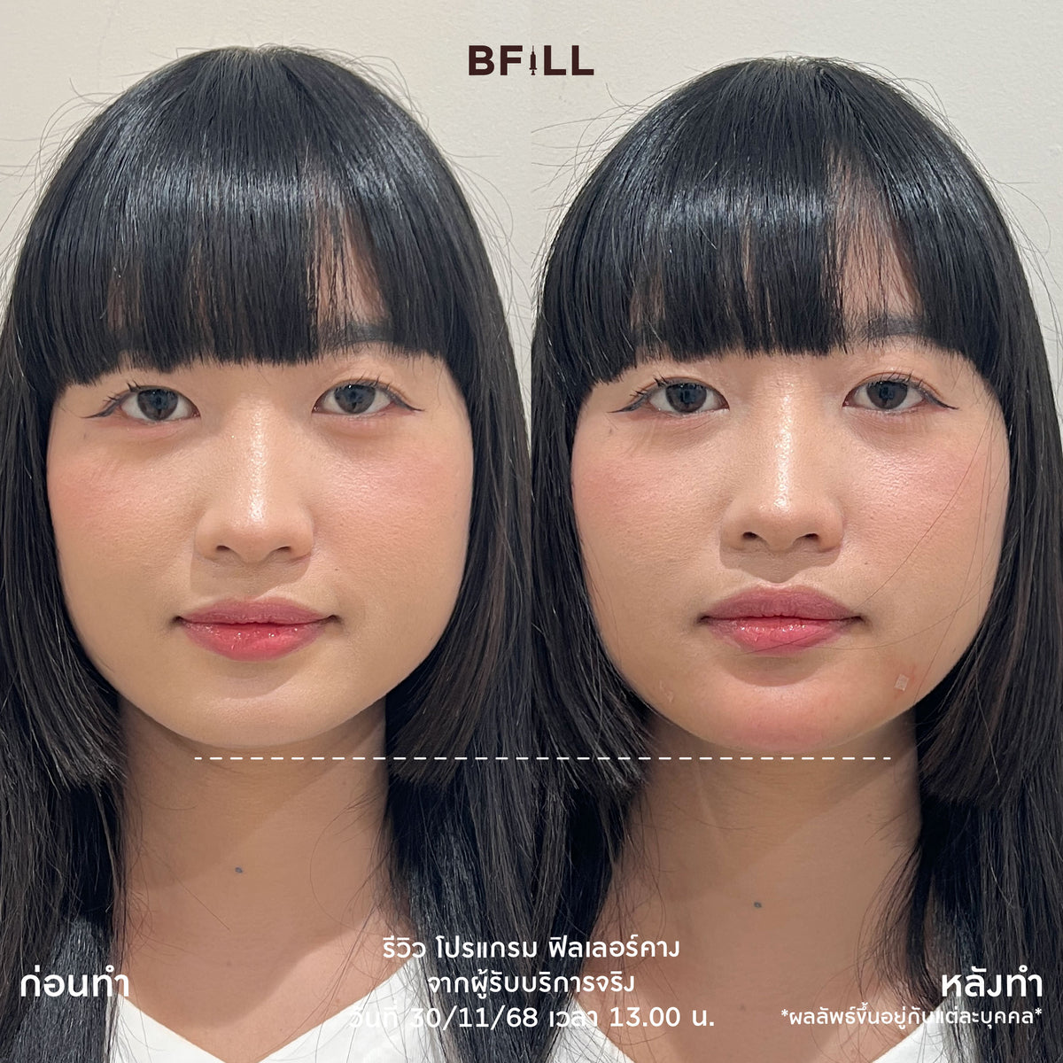 Program FILLER Neuramis or E.P.T.Q. or Volifil or Lorient or Restylane or Juvederm