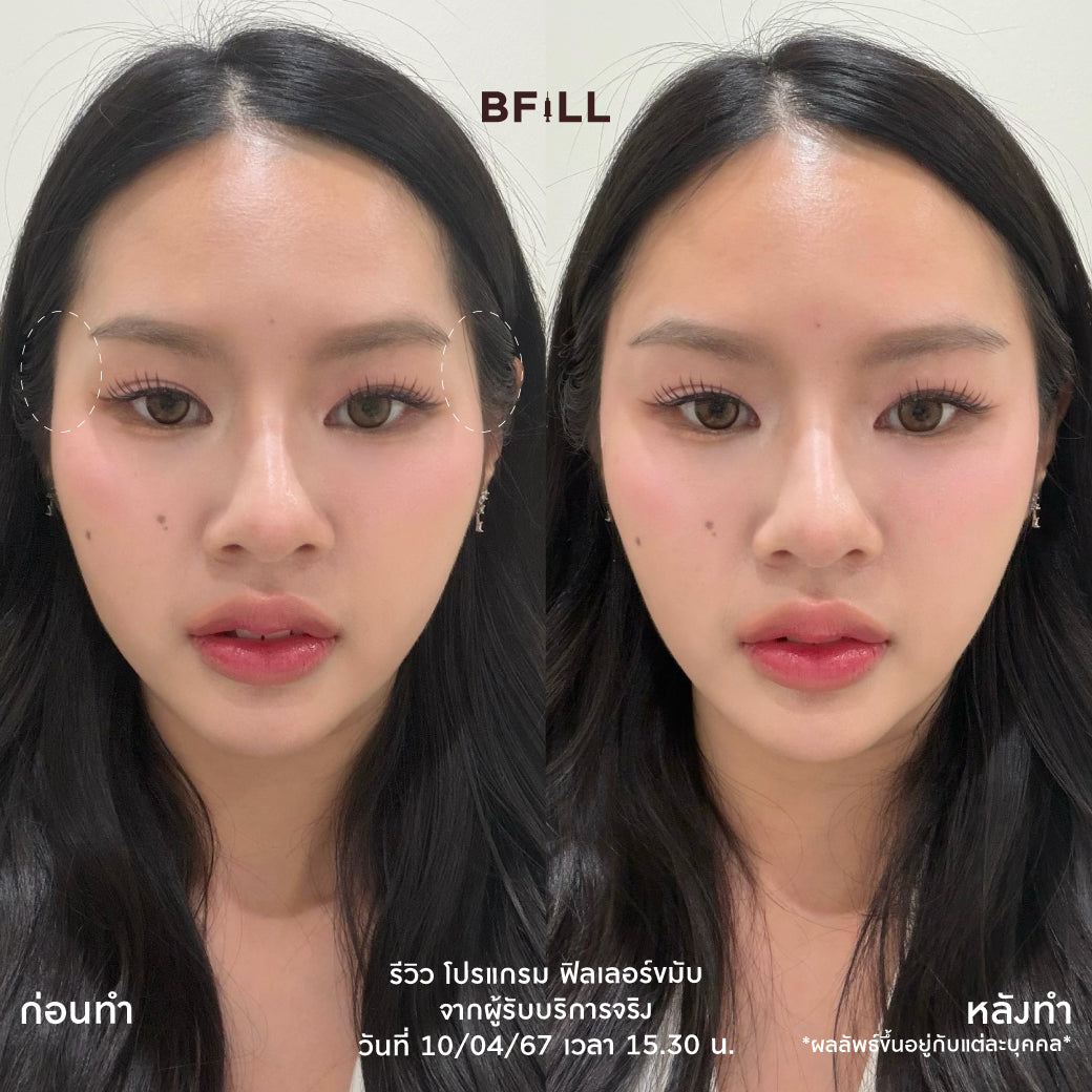 Program FILLER Neuramis or E.P.T.Q. or Volifil or Lorient or Restylane or Juvederm