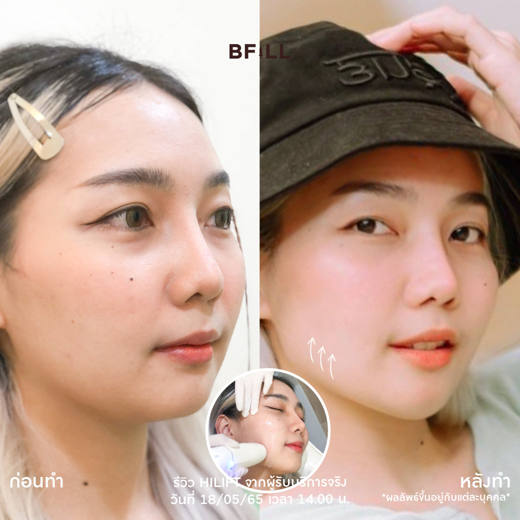 Hifu Hi Lift ไฮลิฟท์ by Specialist (由专家操作) "不包括额头 Excluding forehead" 可分期付款