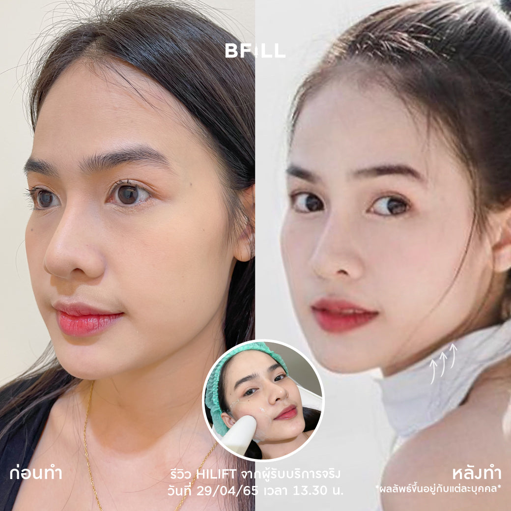 Hifu Hi Lift ไฮลิฟท์ by Specialist (由专家操作) "不包括额头 Excluding forehead" 可分期付款