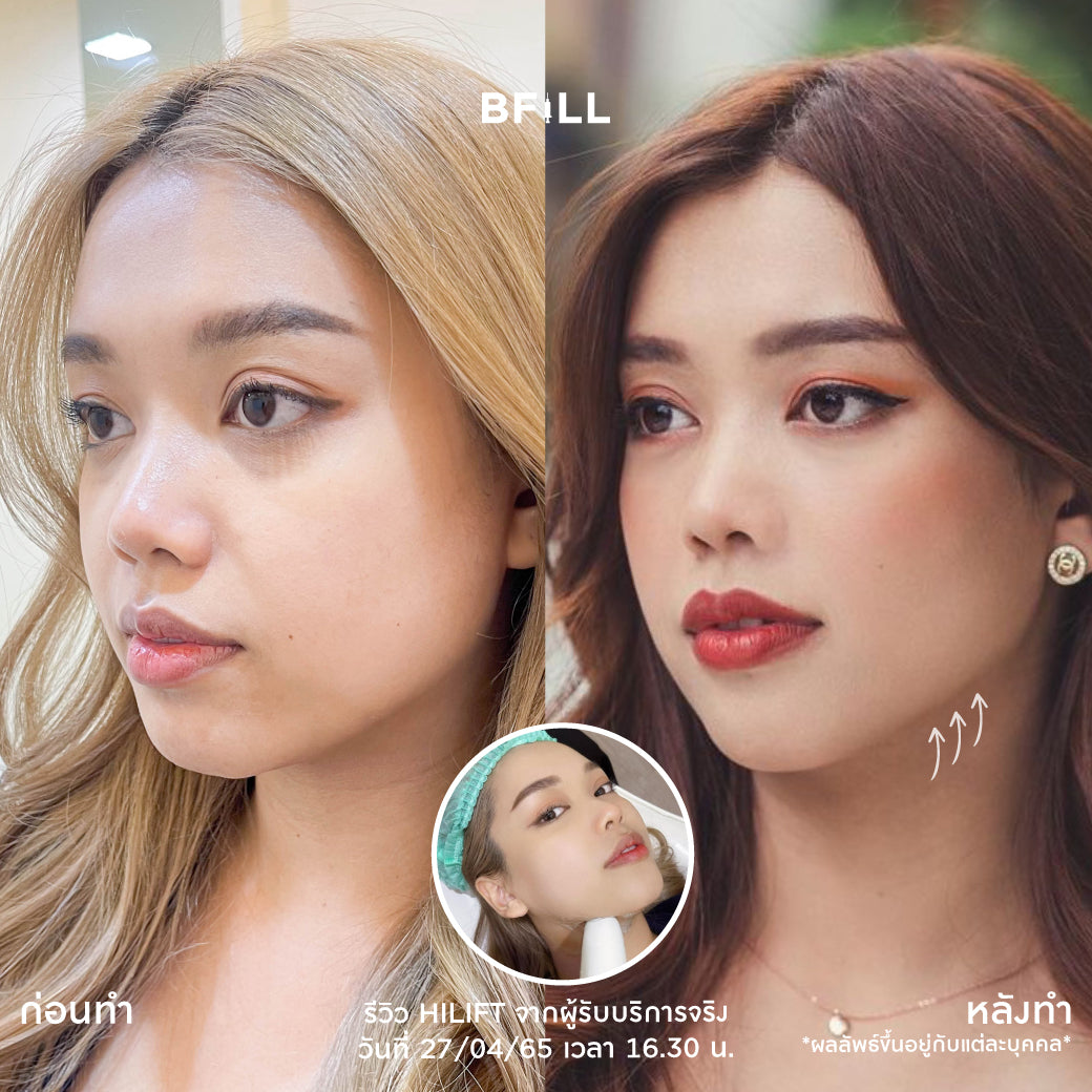 Hifu Hi Lift ไฮลิฟท์ by Specialist (由专家操作) "不包括额头 Excluding forehead" 可分期付款