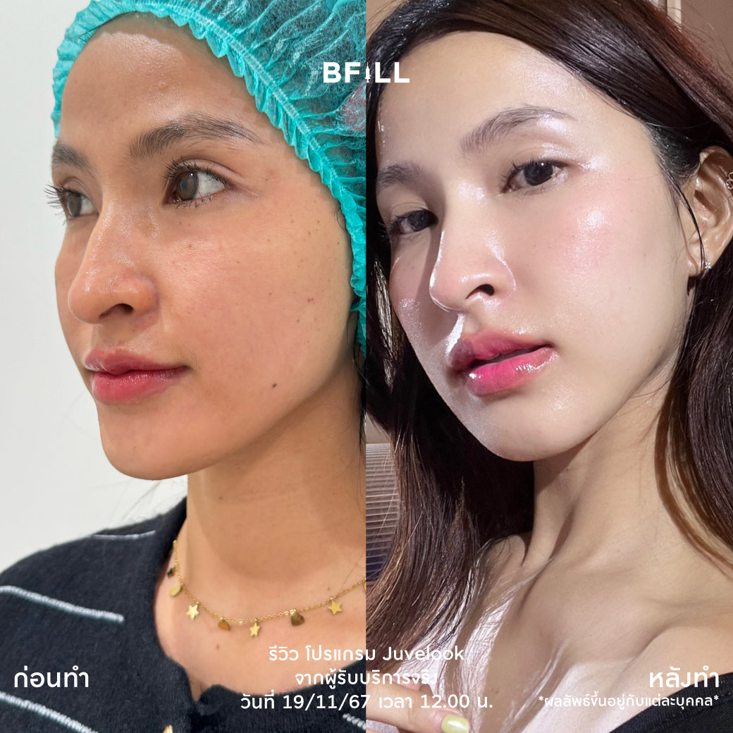 Juvelook项目：Juvelook Skin Booster，不含麻醉药（麻醉药另加200泰铢）