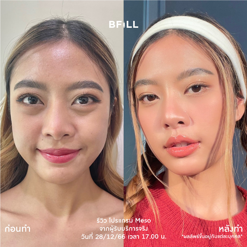 Juvelook项目：Juvelook Skin Booster，不含麻醉药（麻醉药另加200泰铢）