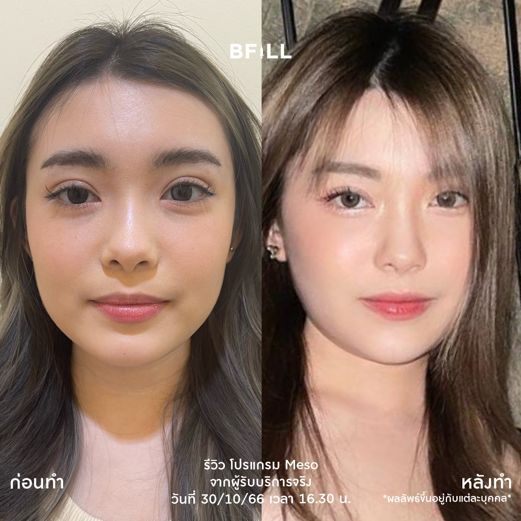 Juvelook Juvelook Skin Booster No.1 Skin Treatment in Korea for 2 Consecutive Years, Only at Asoke and Siam Branches, Excluding Anesthetic (Anesthetic Additional 200 Baht)