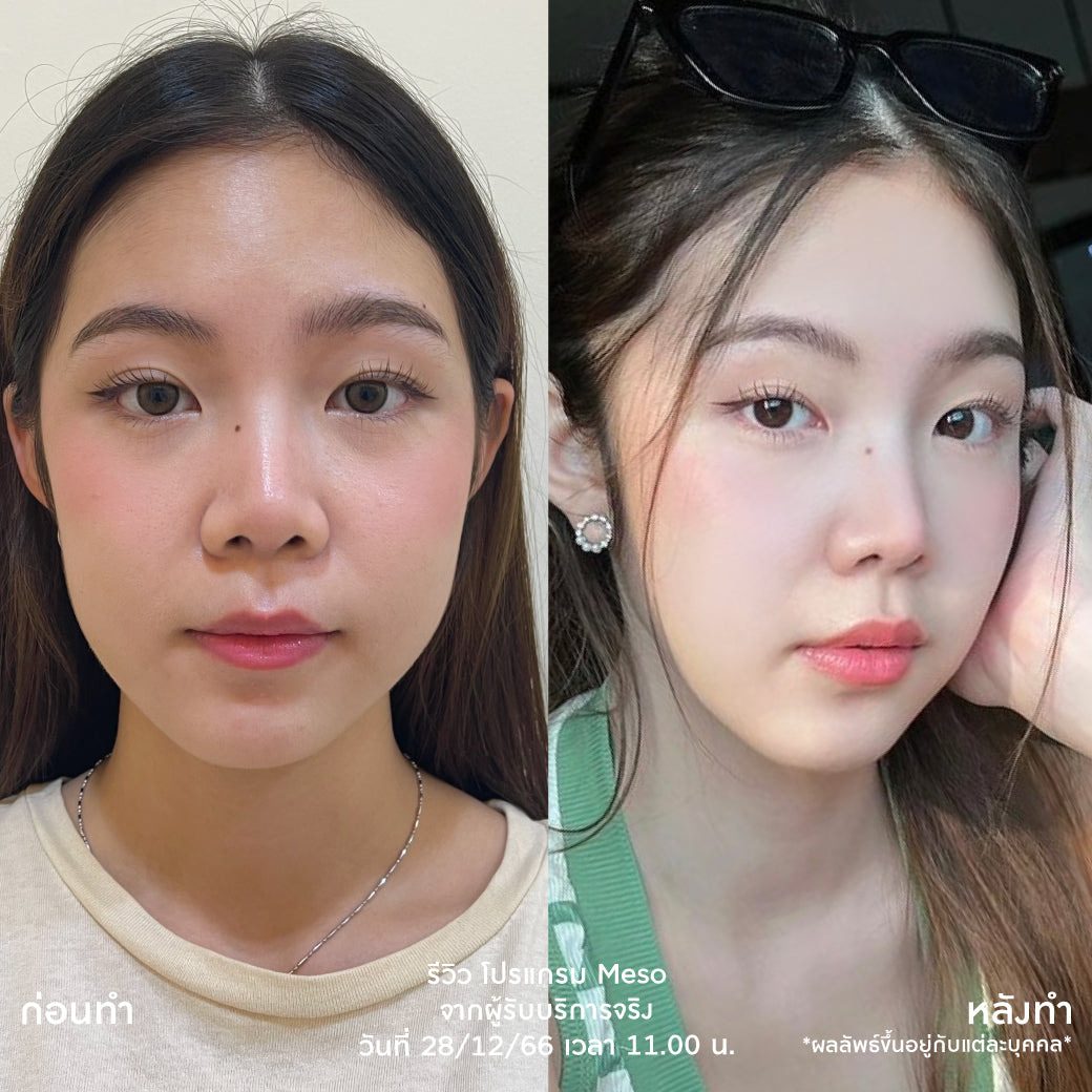 Juvelook Juvelook Skin Booster No.1 Skin Treatment in Korea for 2 Consecutive Years, Only at Asoke and Siam Branches, Excluding Anesthetic (Anesthetic Additional 200 Baht)