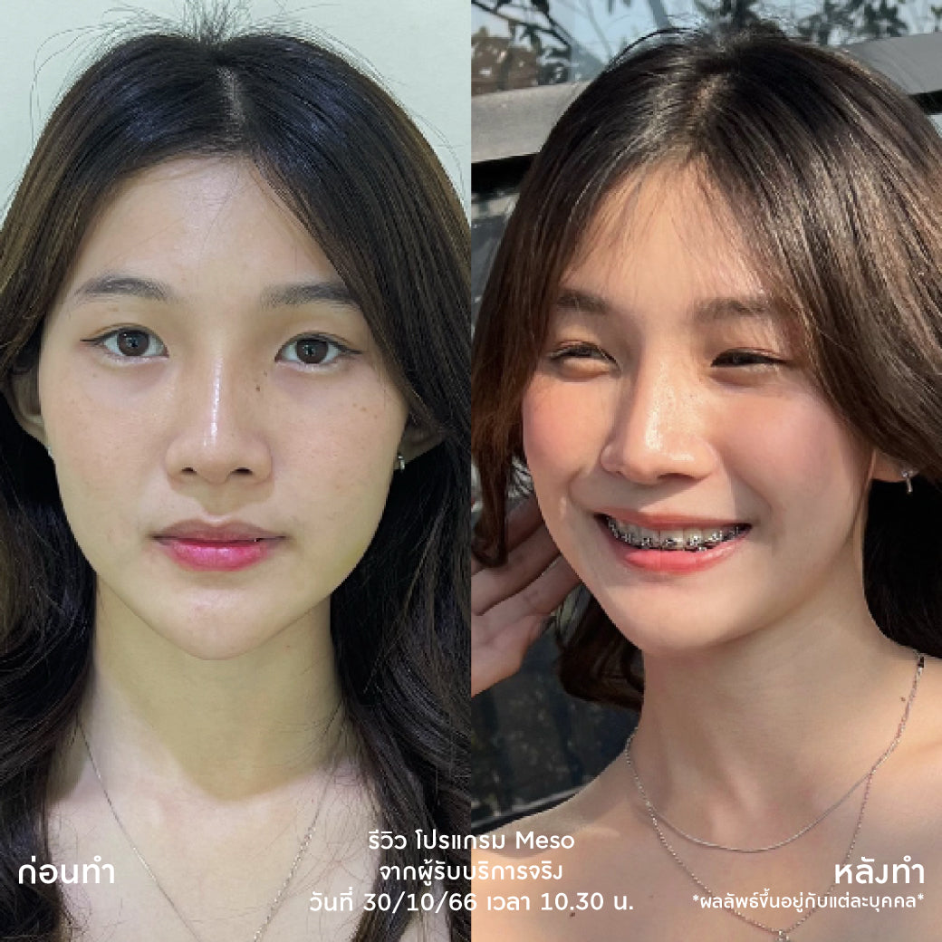 Juvelook项目：Juvelook Skin Booster，不含麻醉药（麻醉药另加200泰铢）