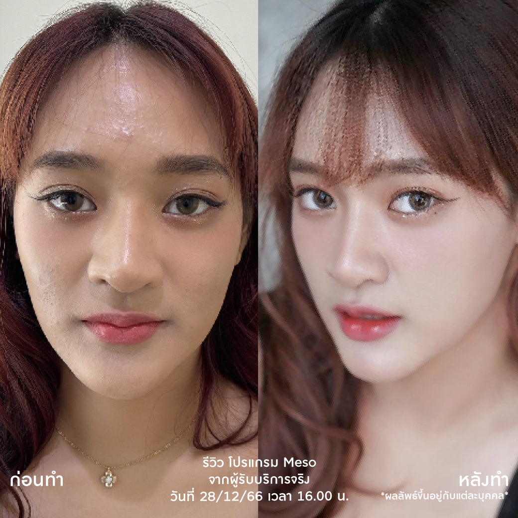 Juvelook项目：Juvelook Skin Booster，不含麻醉药（麻醉药另加200泰铢）