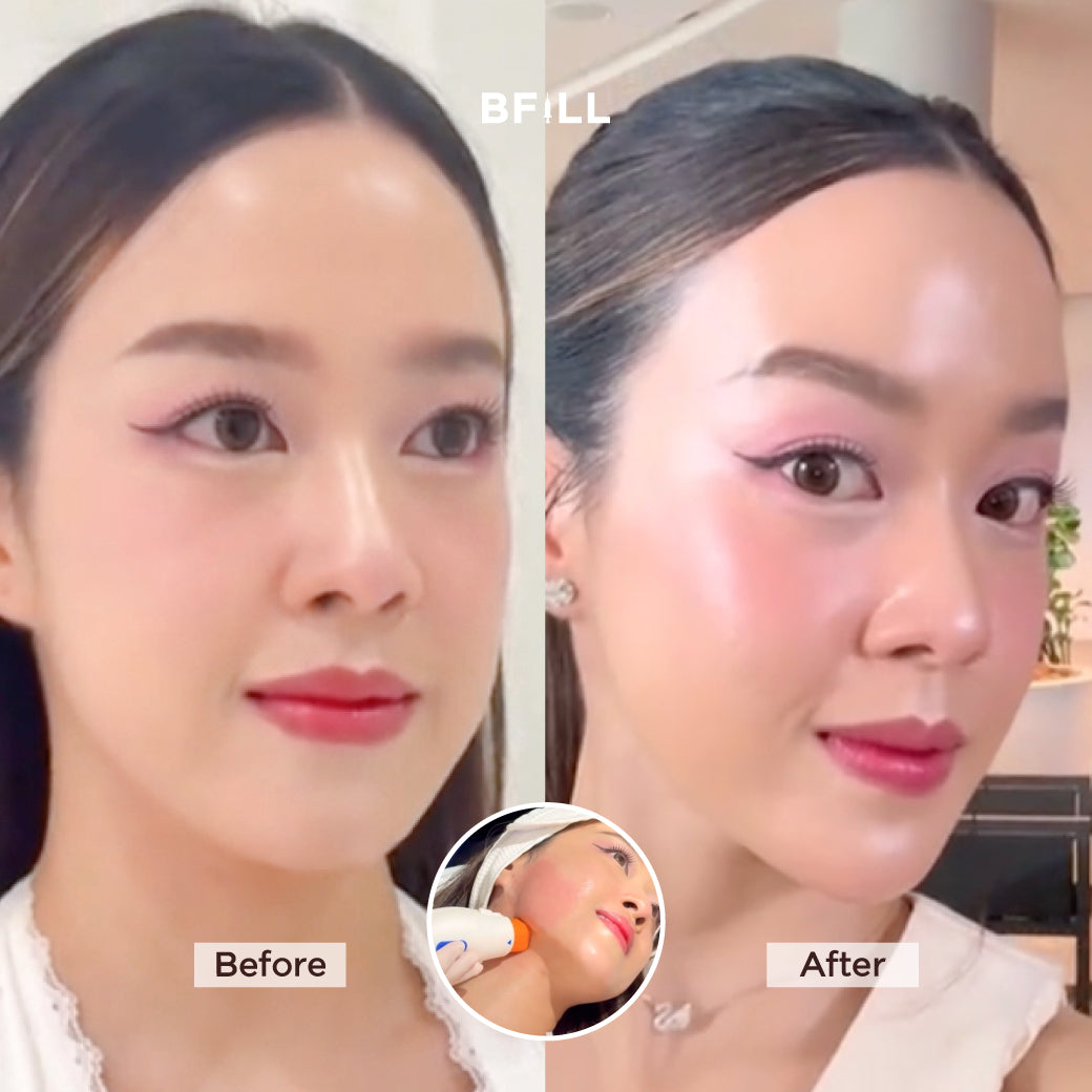Oligio Free Thermage Korea by Doctor New Innovation for Lifting and Firming Latest Genuine Device Only at Asok Branch Only Asok