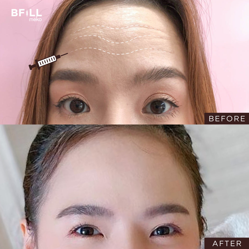 Botox Nabota 博图克 Nabota