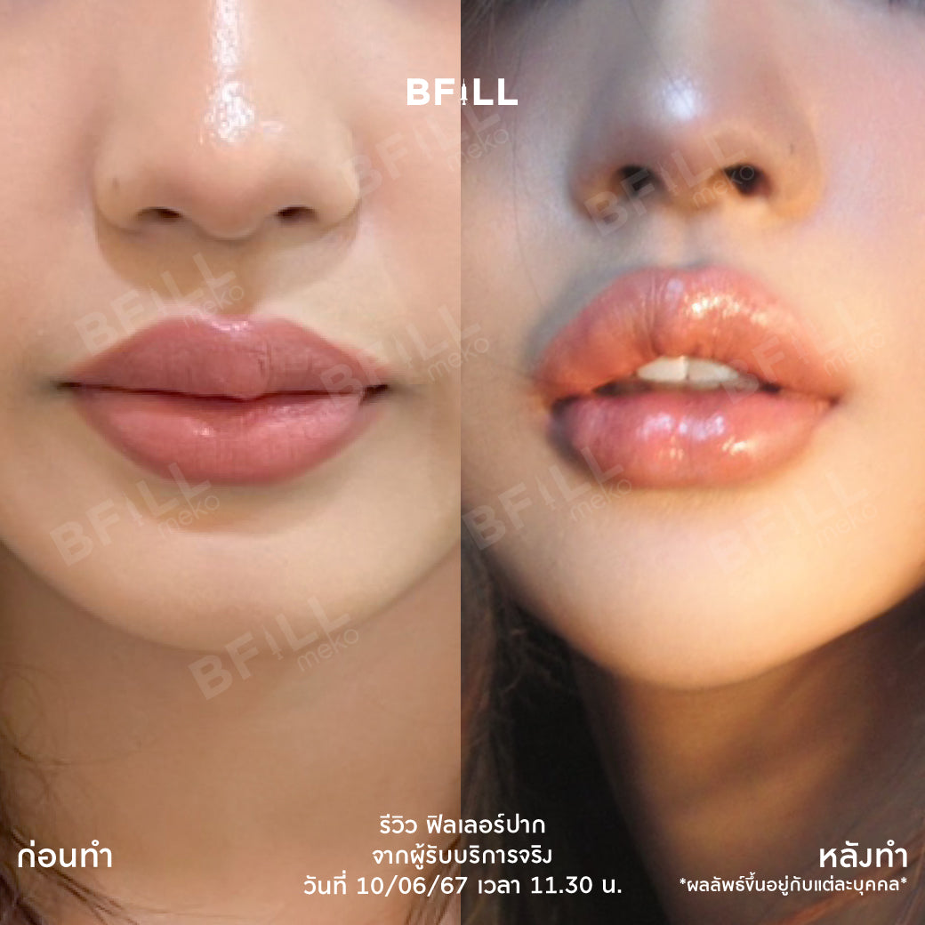 FILLER 韩国或瑞蓝或乔雅登