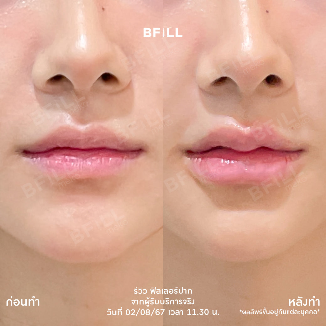 FILLER 韩国或瑞蓝或乔雅登