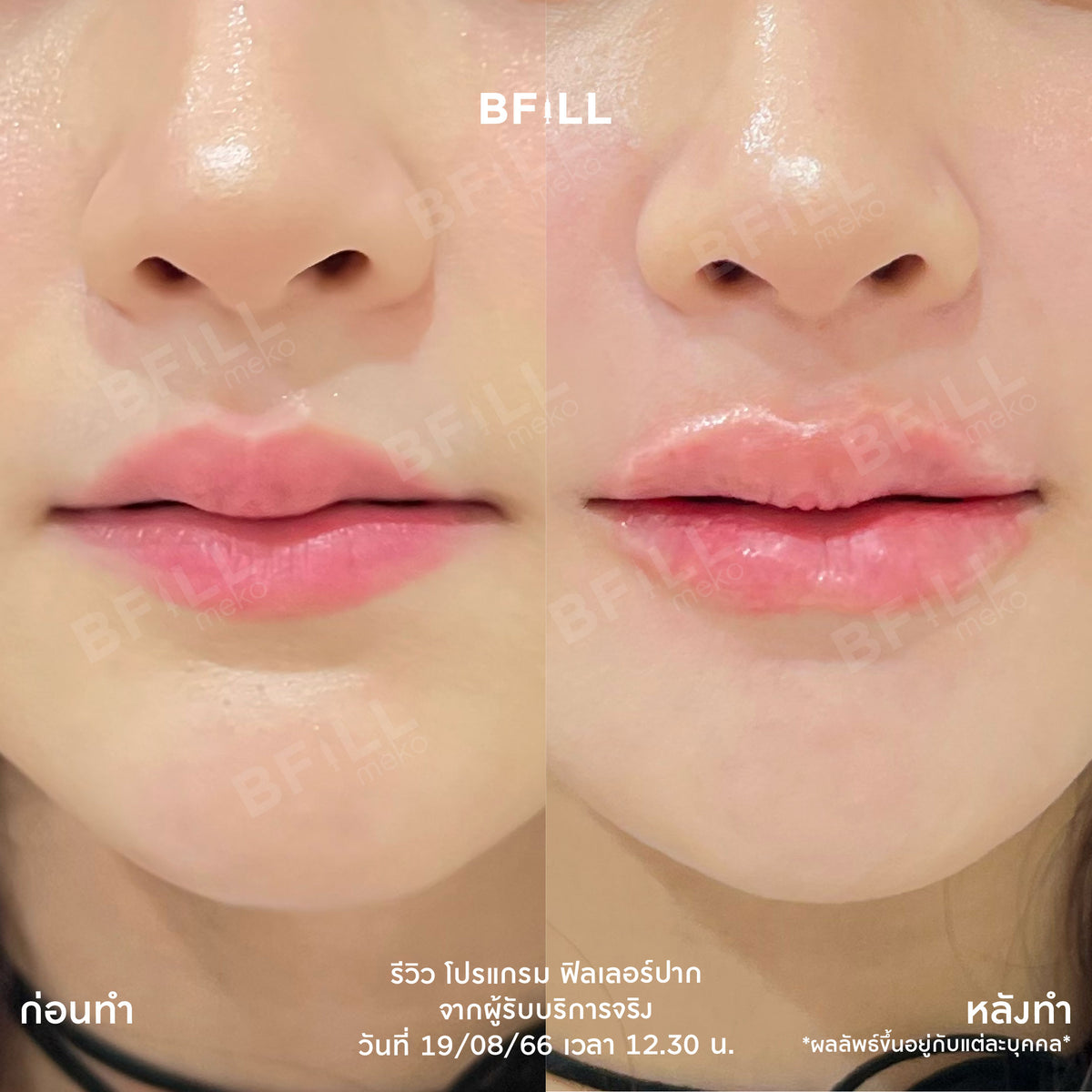 Program FILLER Neuramis or E.P.T.Q. or Volifil or Lorient or Restylane or Juvederm