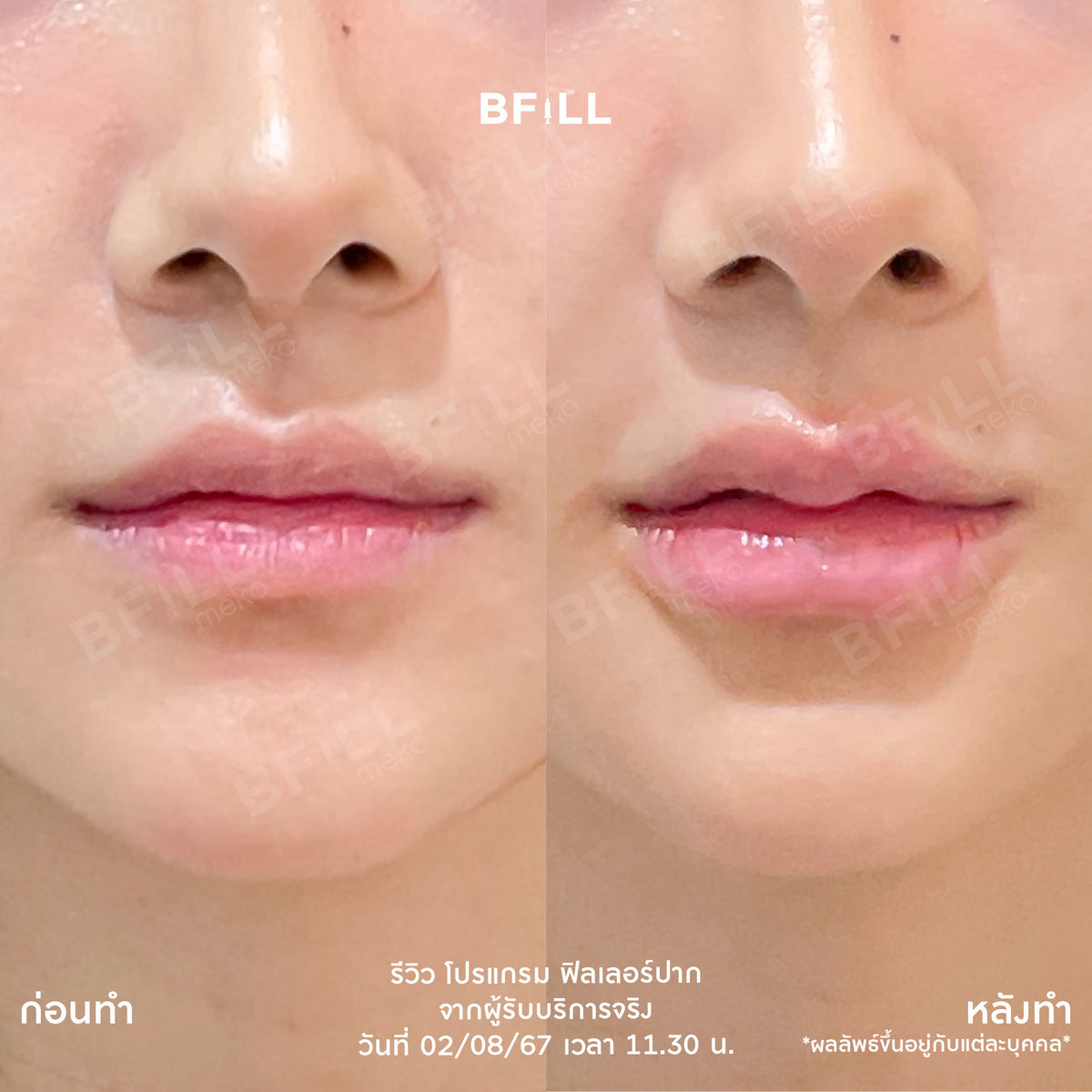 Program FILLER Neuramis or E.P.T.Q. or Volifil or Lorient or Restylane or Juvederm
