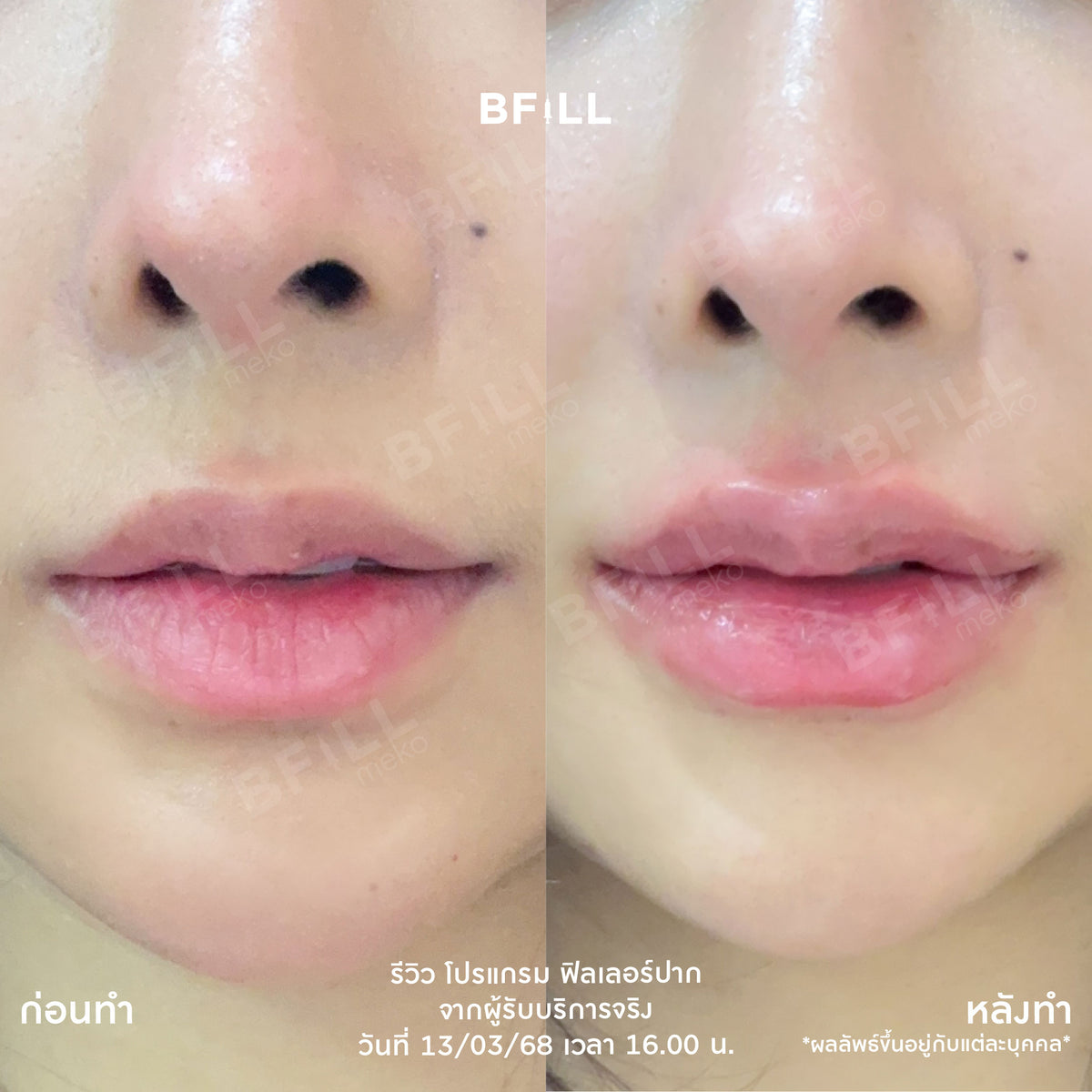 Program FILLER Neuramis or E.P.T.Q. or Volifil or Lorient or Restylane or Juvederm