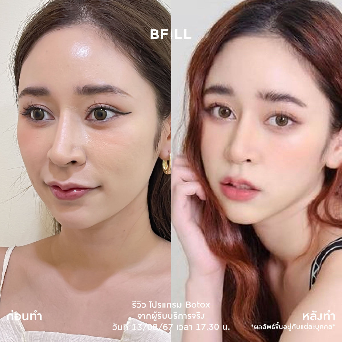 Program Botox Nabota
