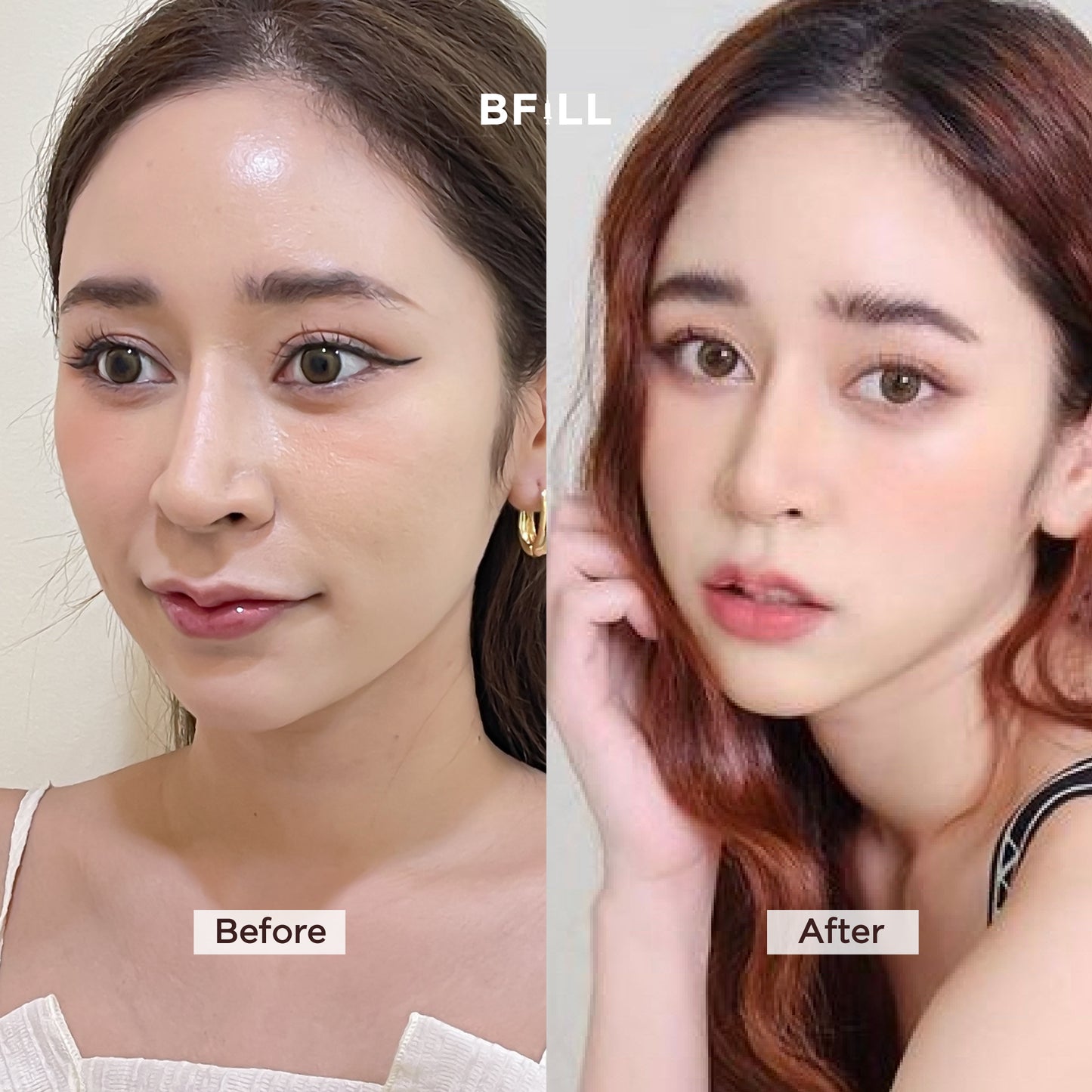 Botox Allergan 100U โบท็อก อเมริกา เลือกบริเวณฉีดได้ Only Asok