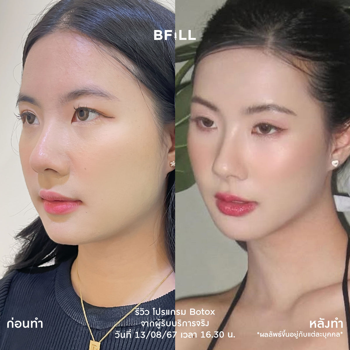 Program Botox Nabota