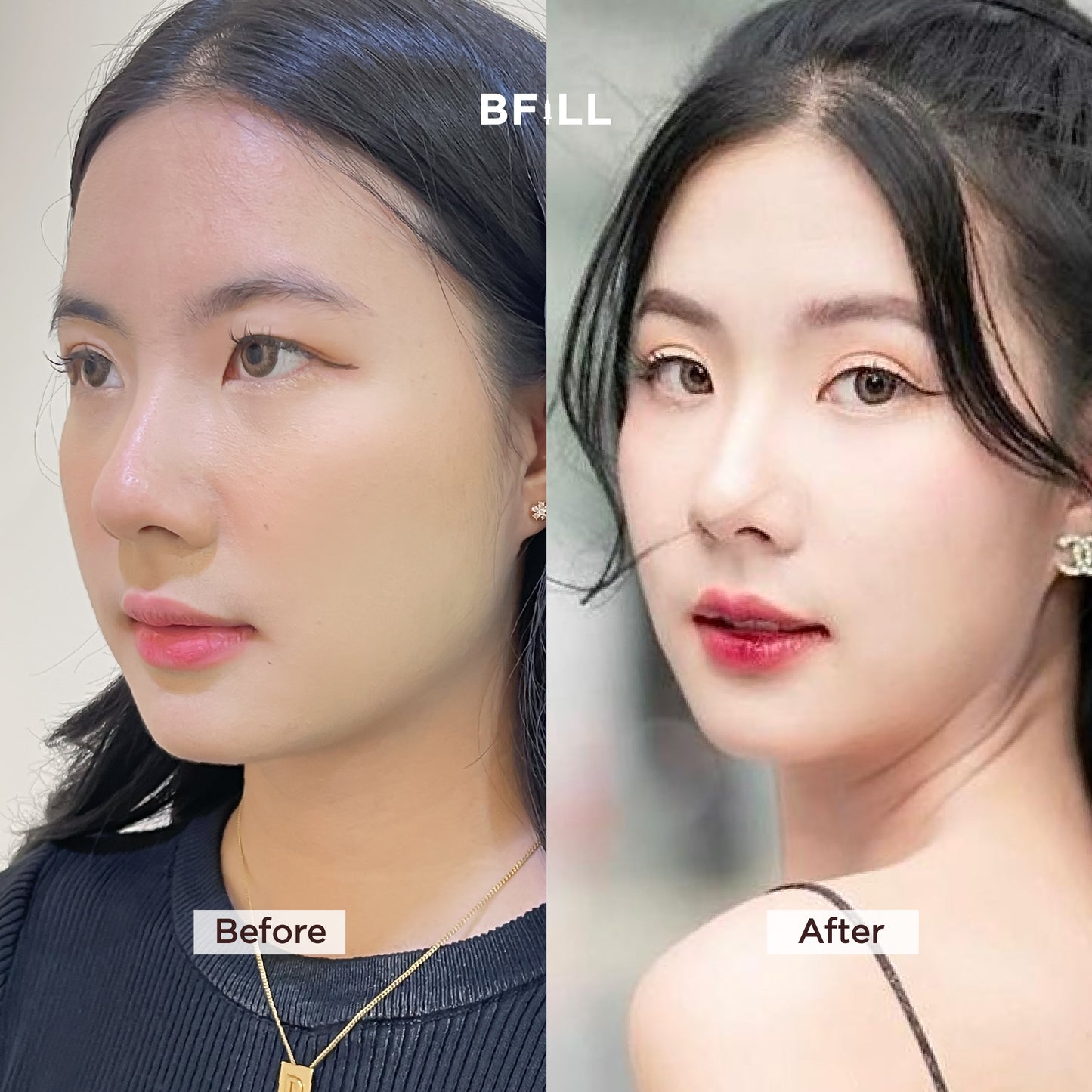 Botox Xeomin 100U โบท็อก เยอรมัน เลือกบริเวณฉีดได้ Only Asok