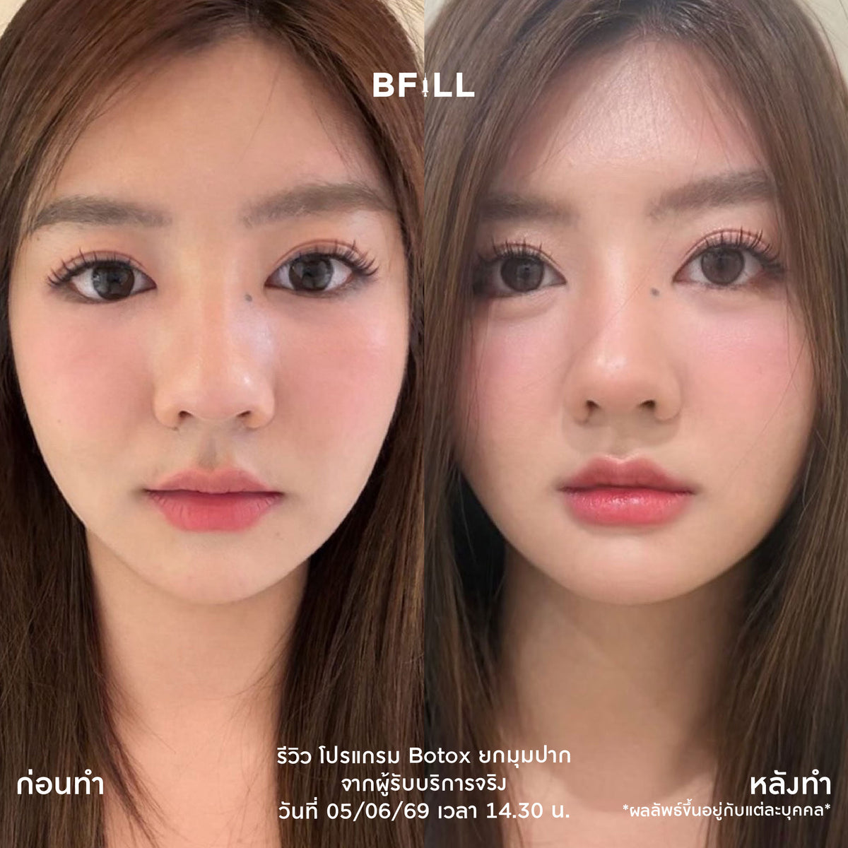 Program Botox Nabota